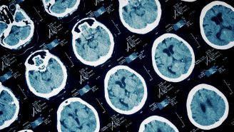Do brain injuries lead to dementia?