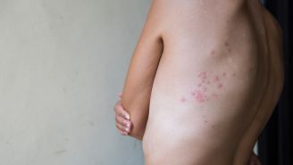 If you had chickenpox, you may also develop shingles—here's how