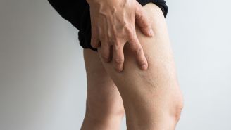 Are spider veins anything to worry about?