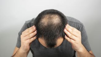 Is testosterone making you go bald?