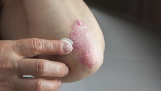 A guide to understanding psoriasis inflammation