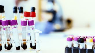 5 answers about molecular testing and acute myeloid leukemia