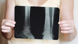 5 Common Myths About Osteoporosis, Debunked