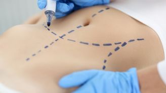 Skin removal surgery after weight loss