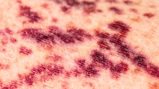 Why ITP causes bleeding and bruising symptoms