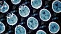 Do Brain Injuries Lead to Dementia?