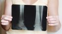 5 common myths about osteoporosis, debunked