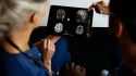 Should You Seek a Second Opinion for a Glioma Diagnosis?