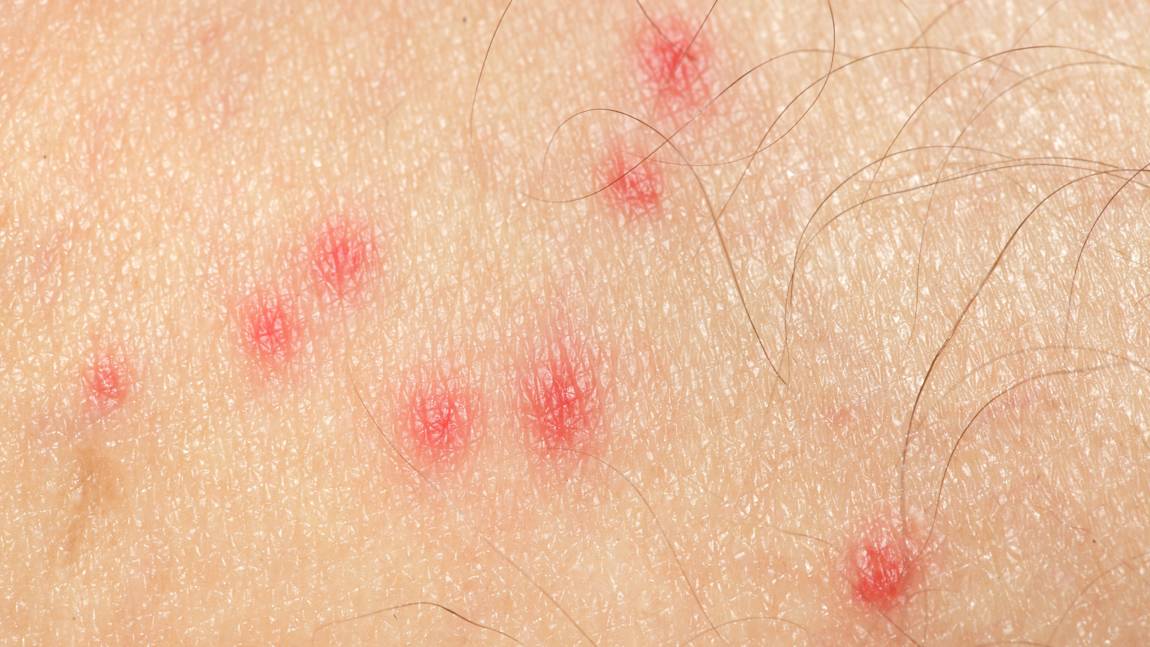 Ouch, what bit me? 10 common bug bites