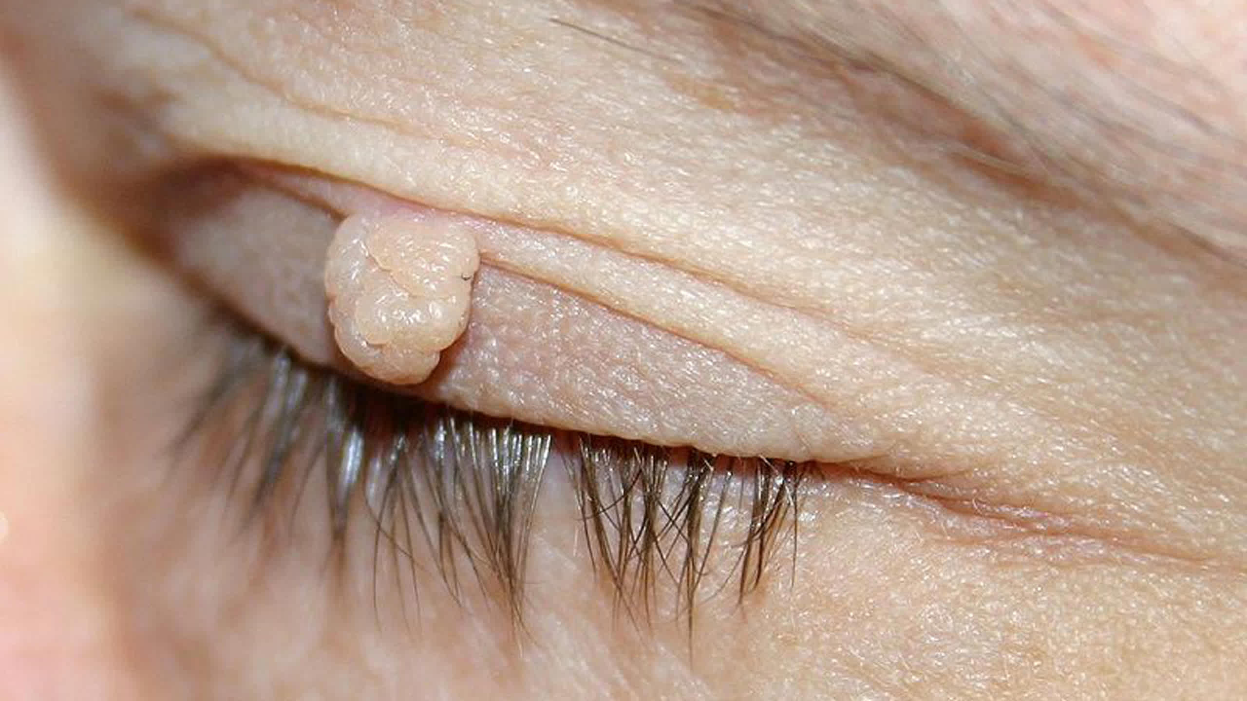 Skin tags