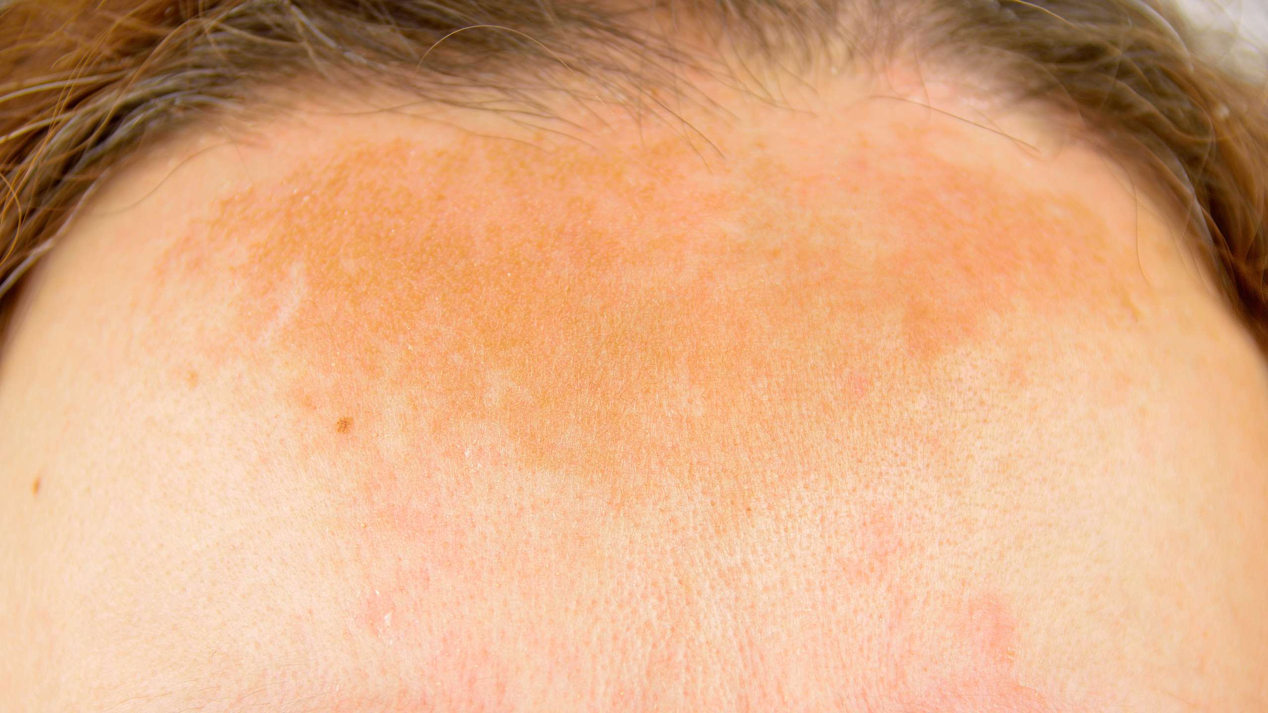 Melasma