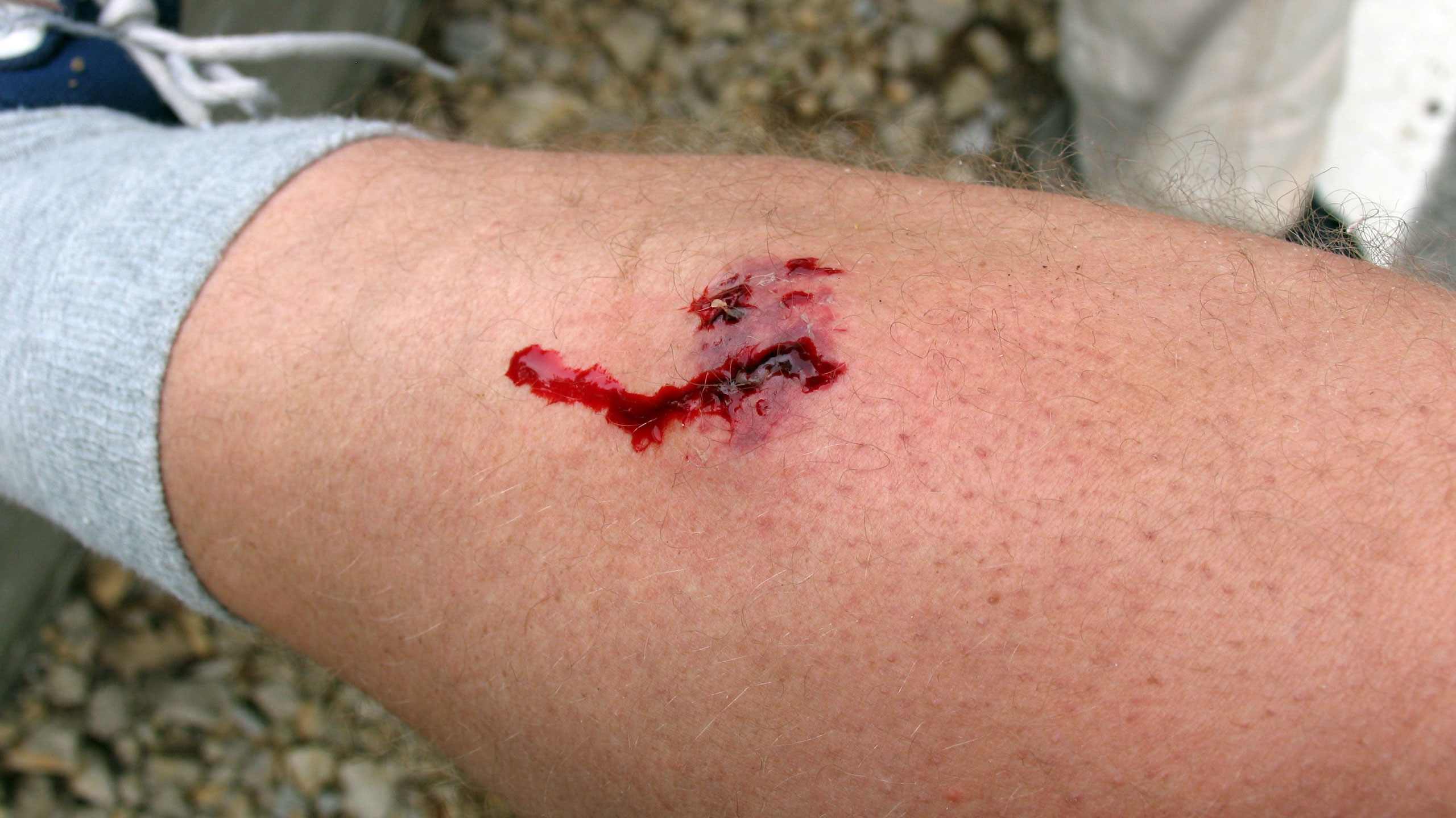 Animal and human bites