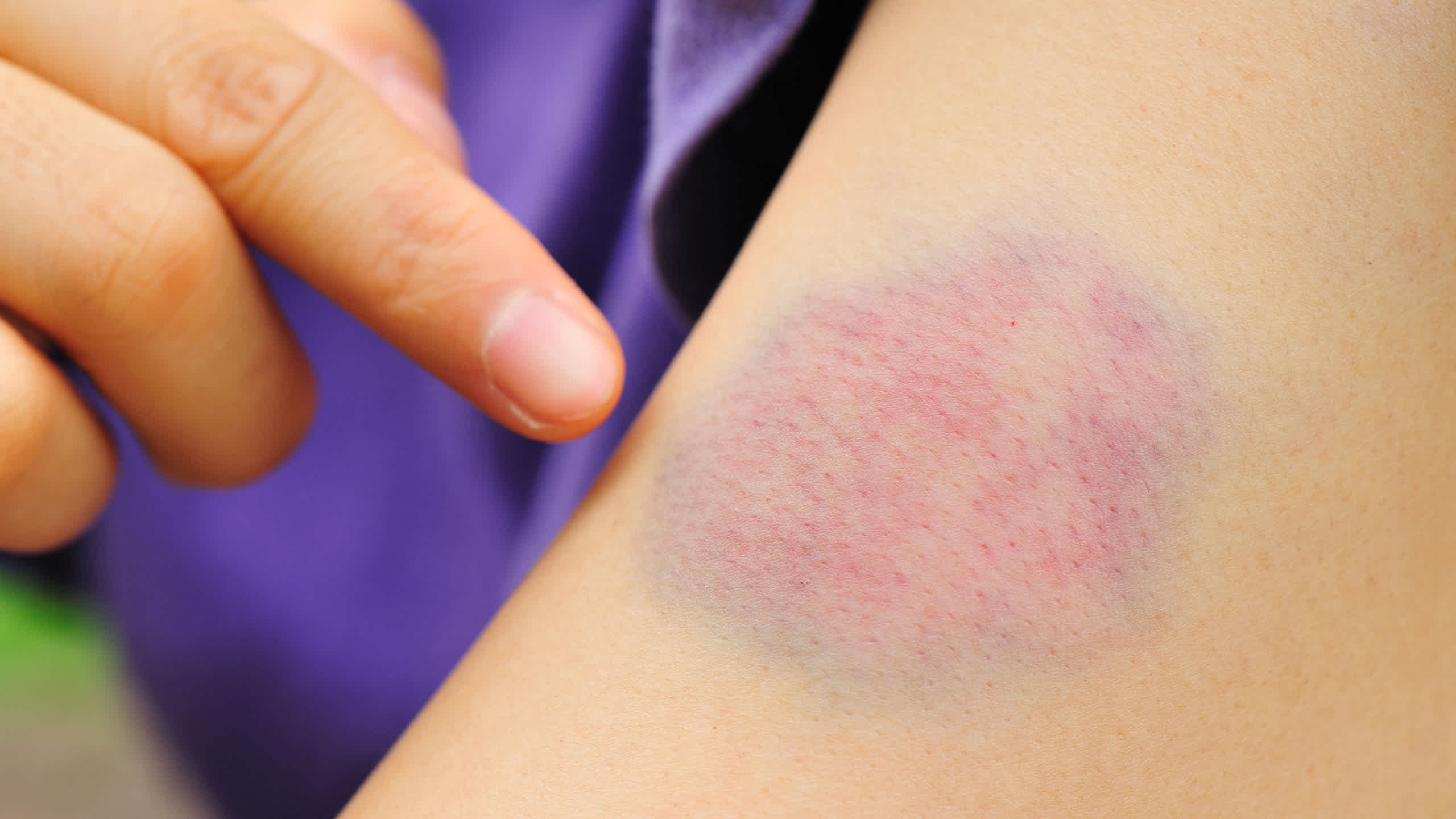 Contusions