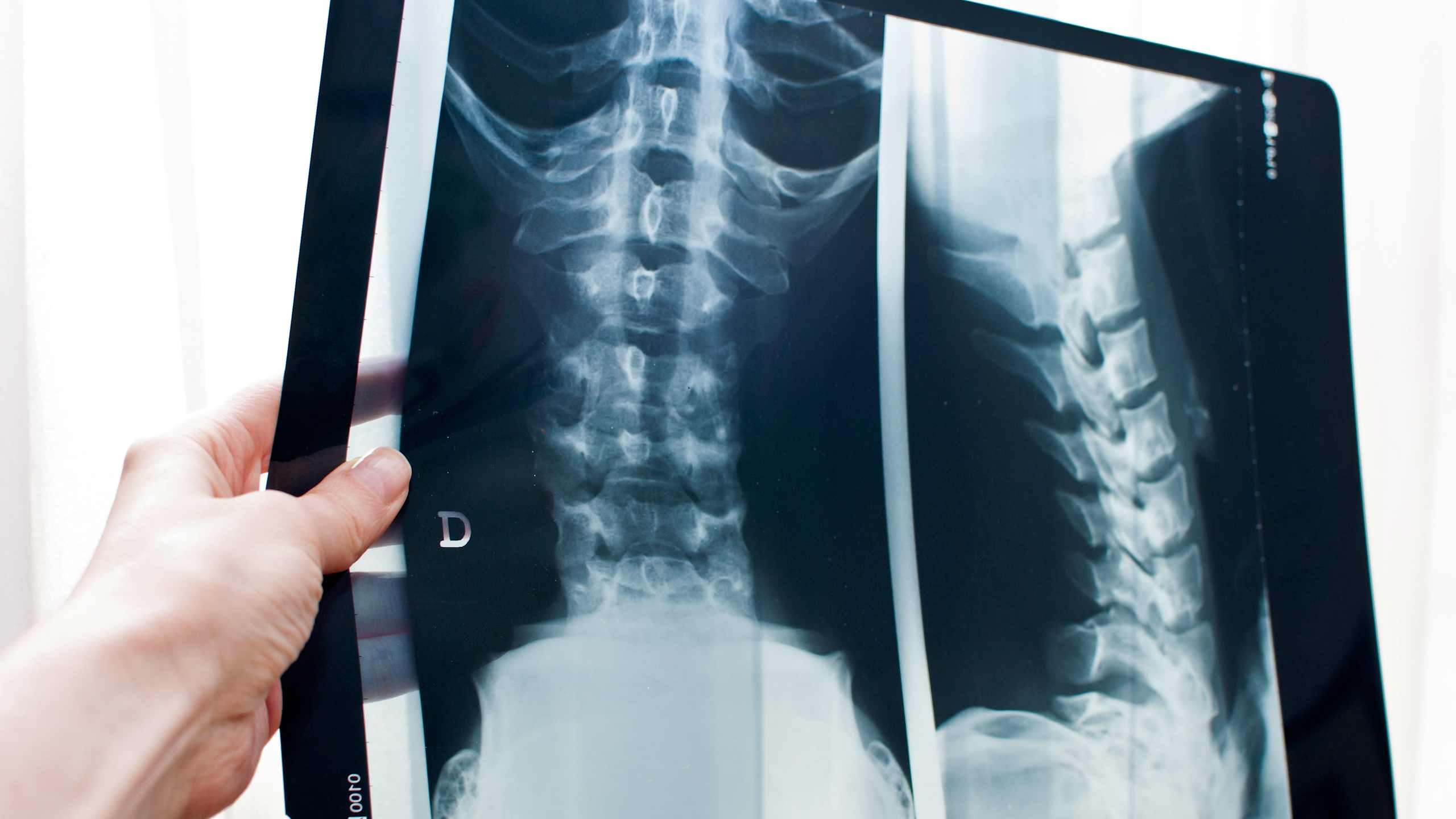 Herniated disks