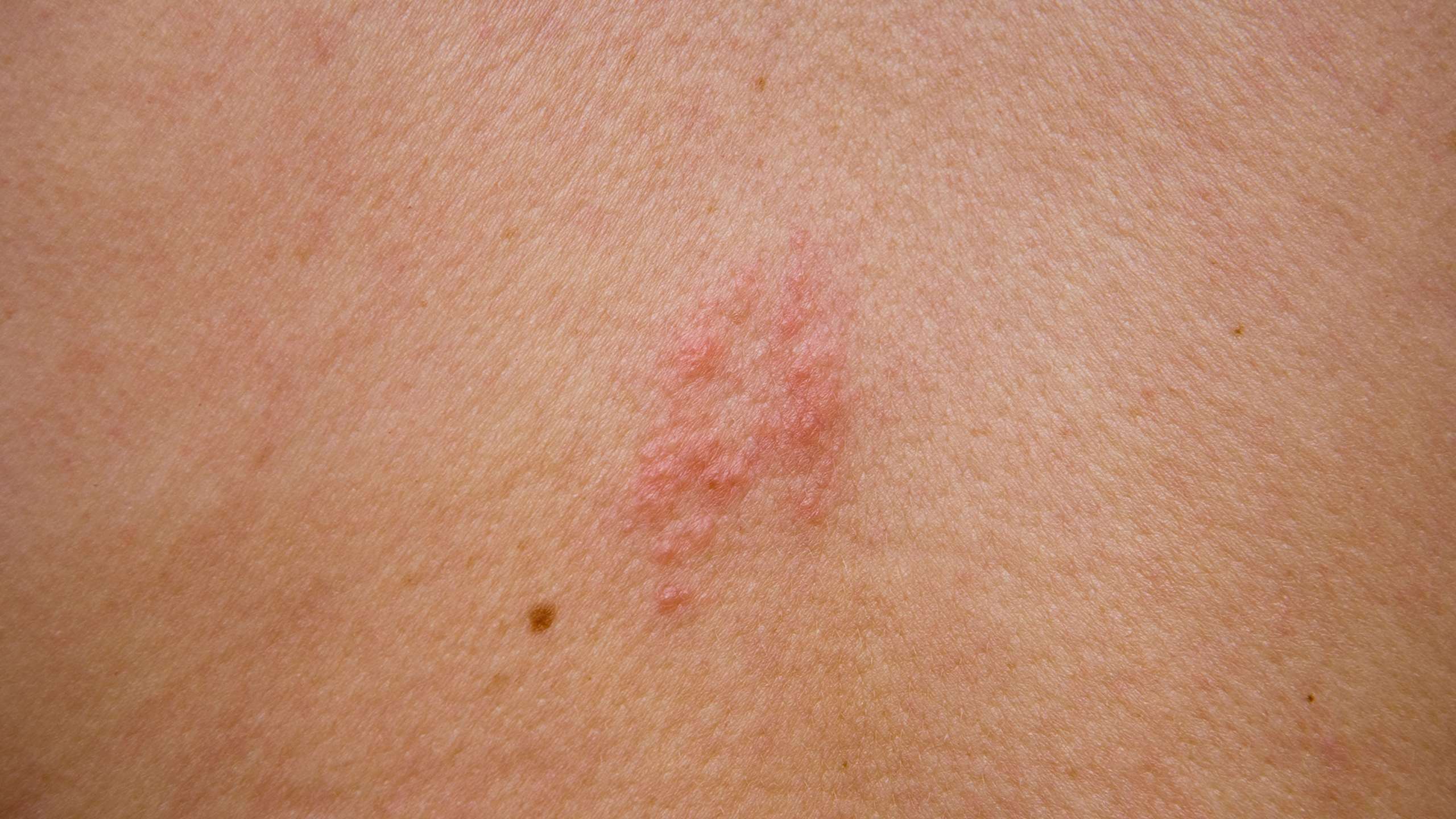 Can you have Shingles twice?