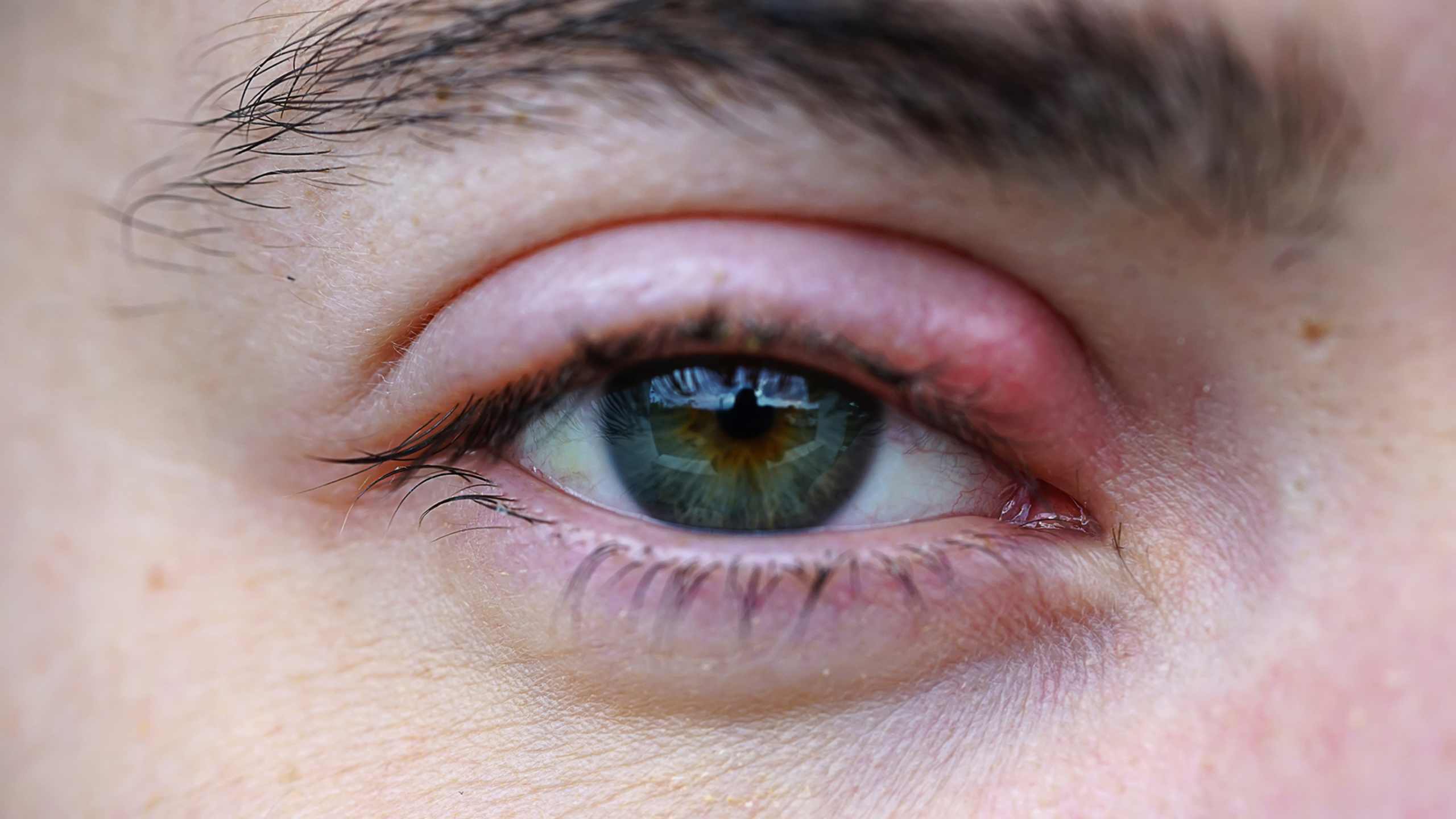 Boils and styes