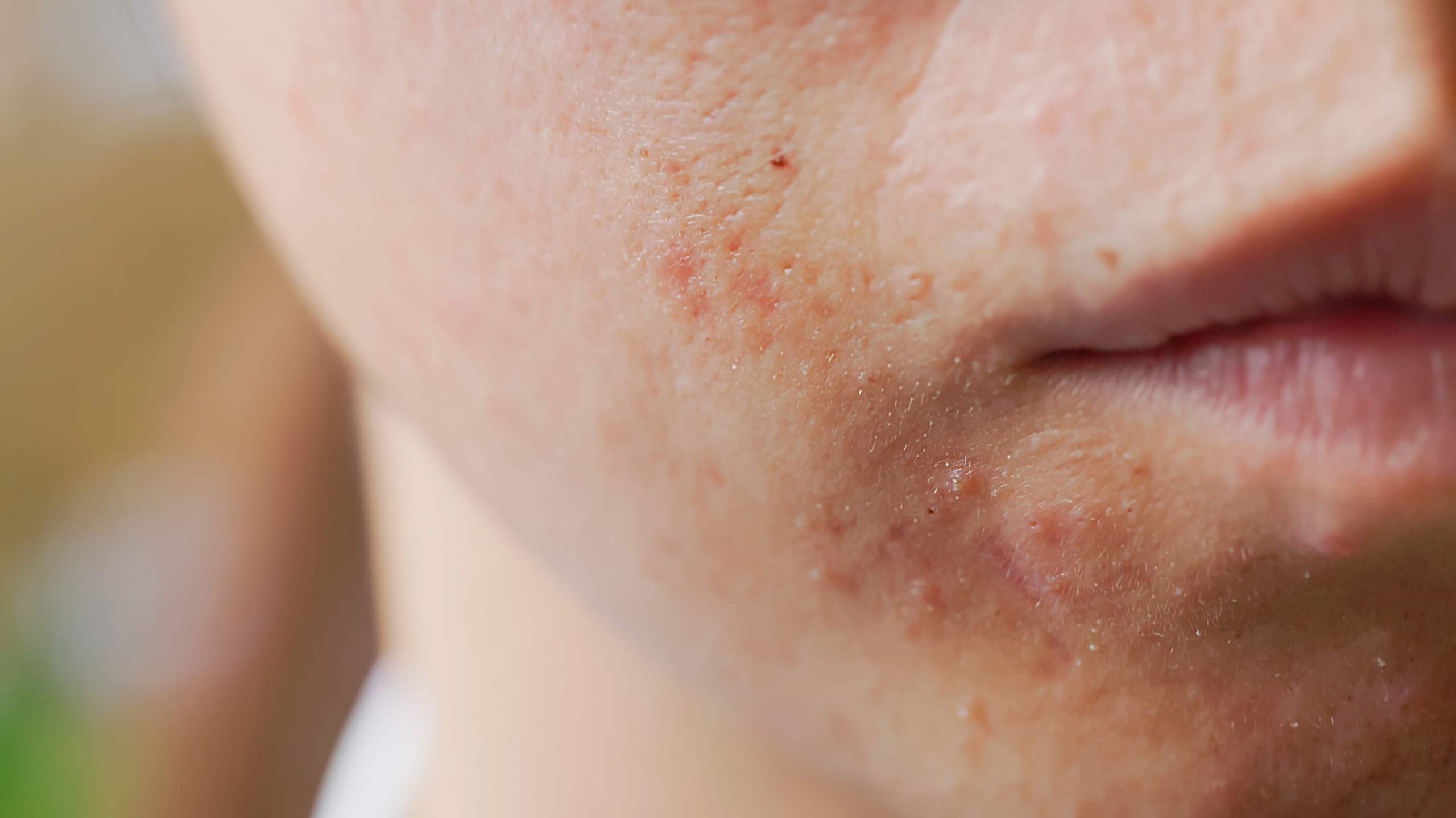 Not all pimples are created equal