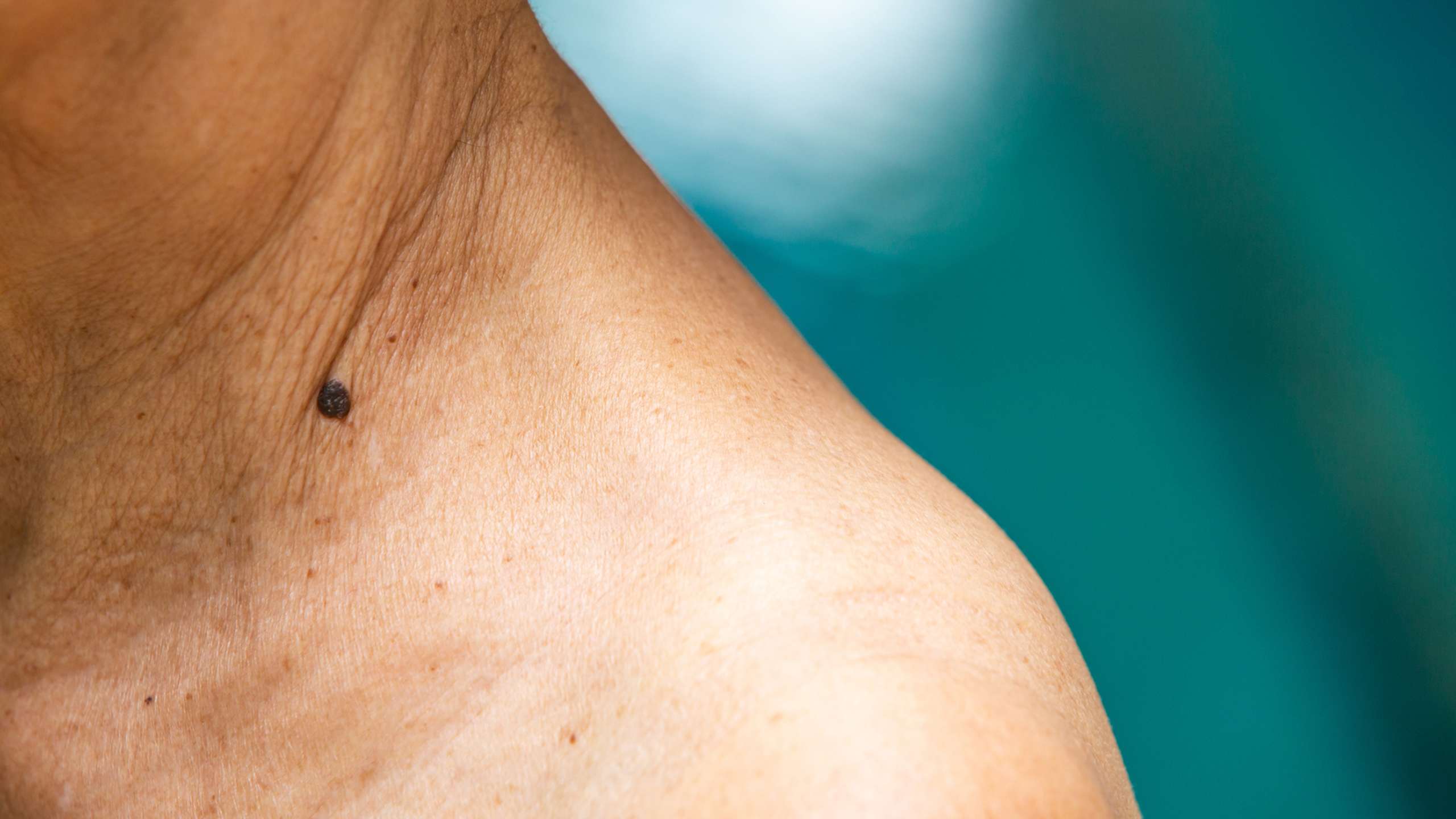 How to spot Skin Cancer