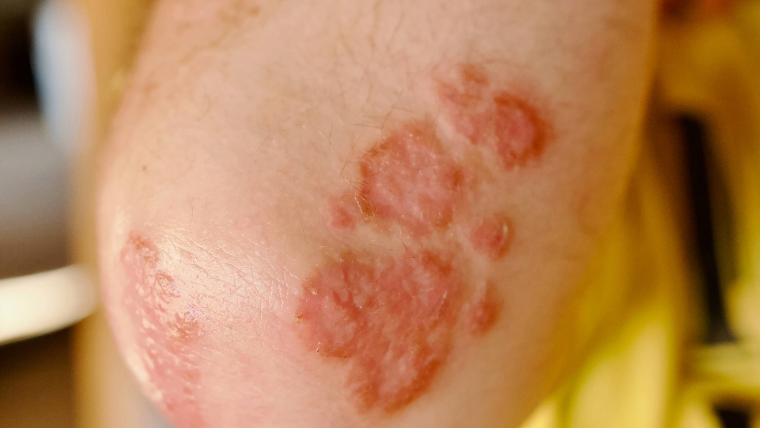 Psoriasis, skin symptoms, and the immune system