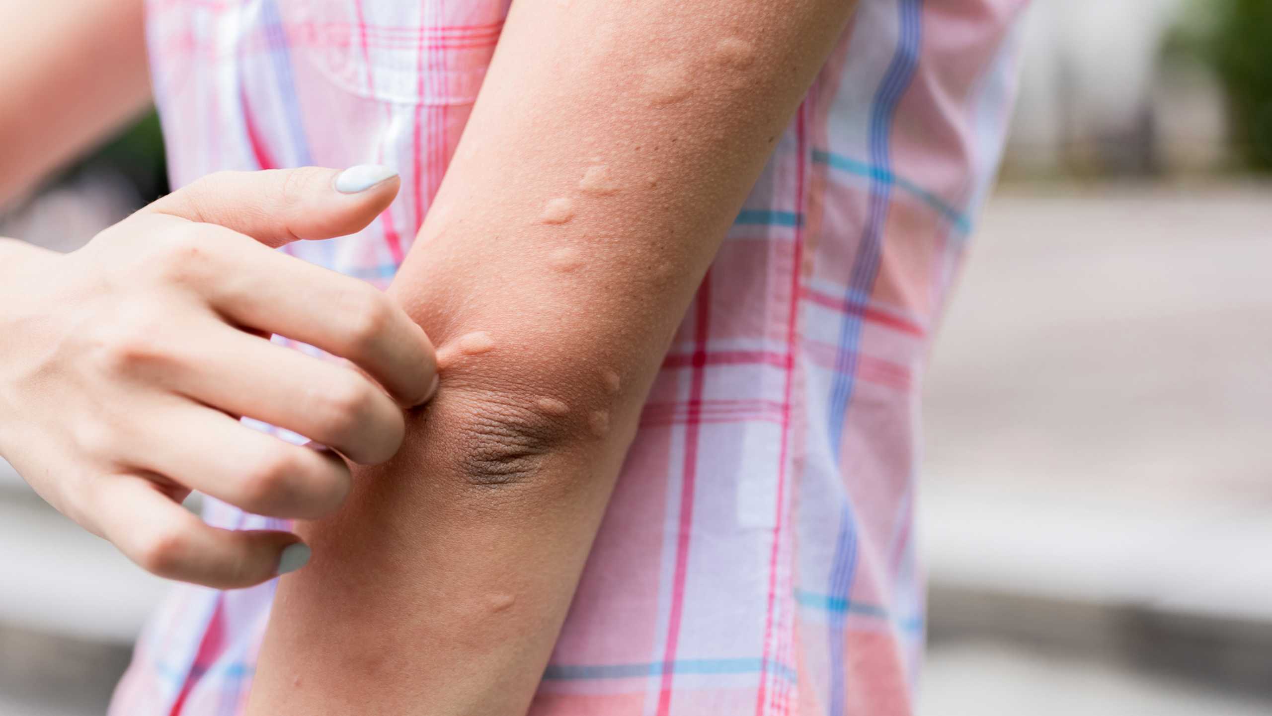 Is chronic spontaneous urticaria an autoimmune disease?