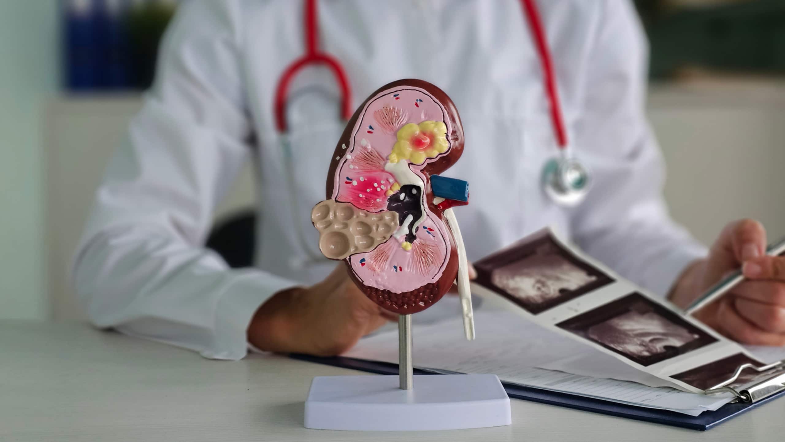 IGA nephropathy: understanding the complement system