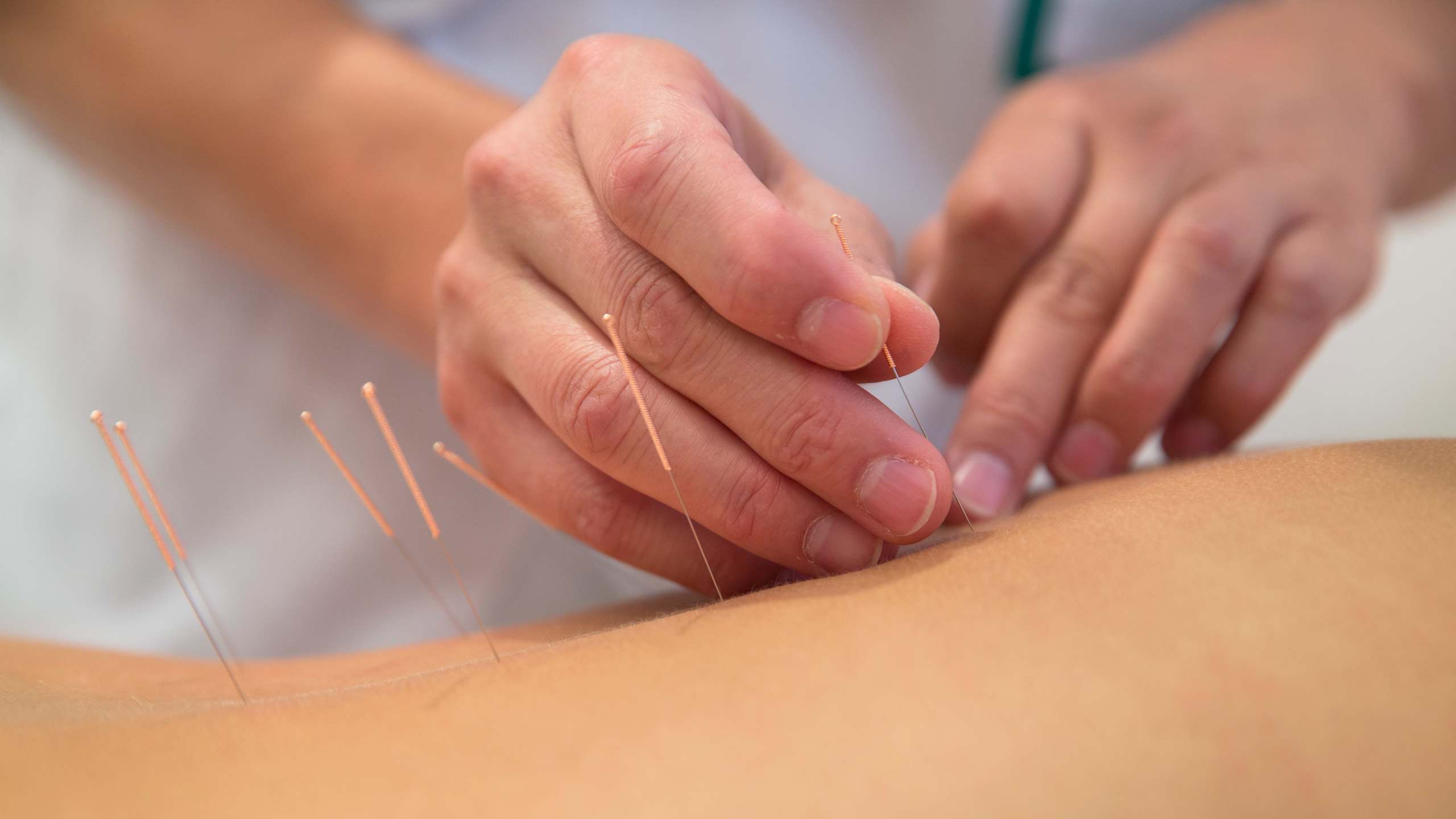 Acupuncture