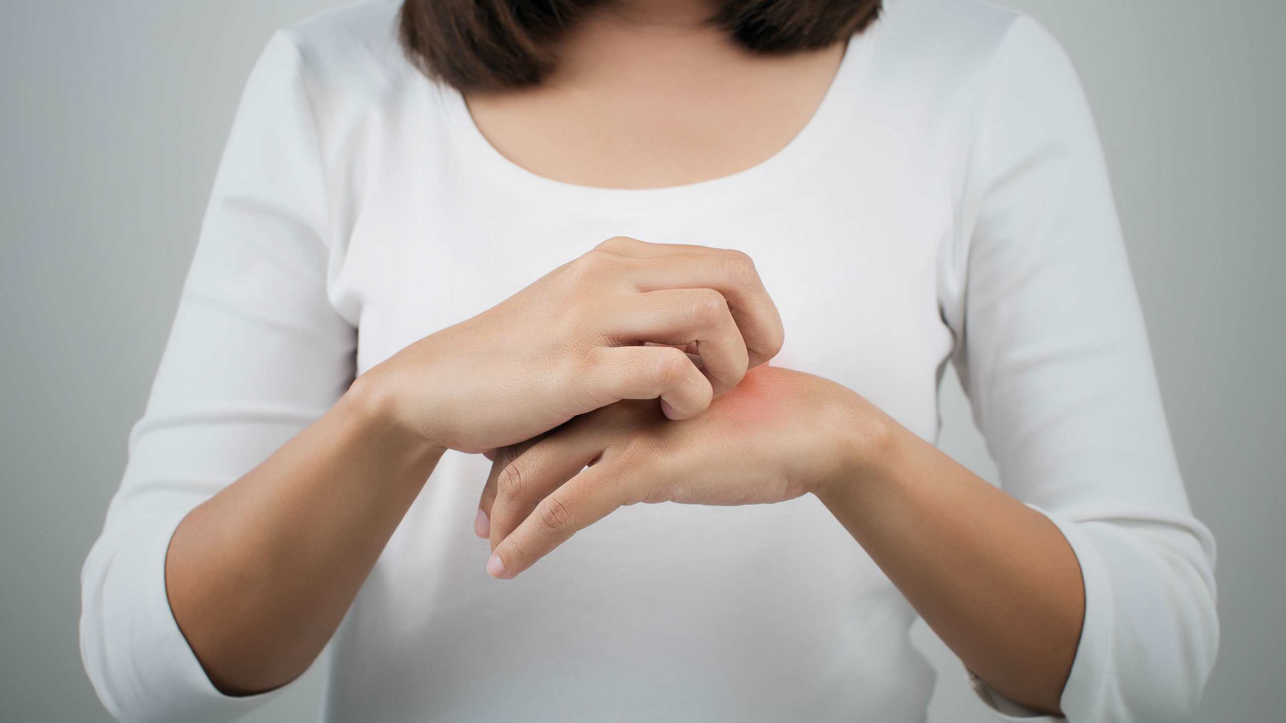Eczema