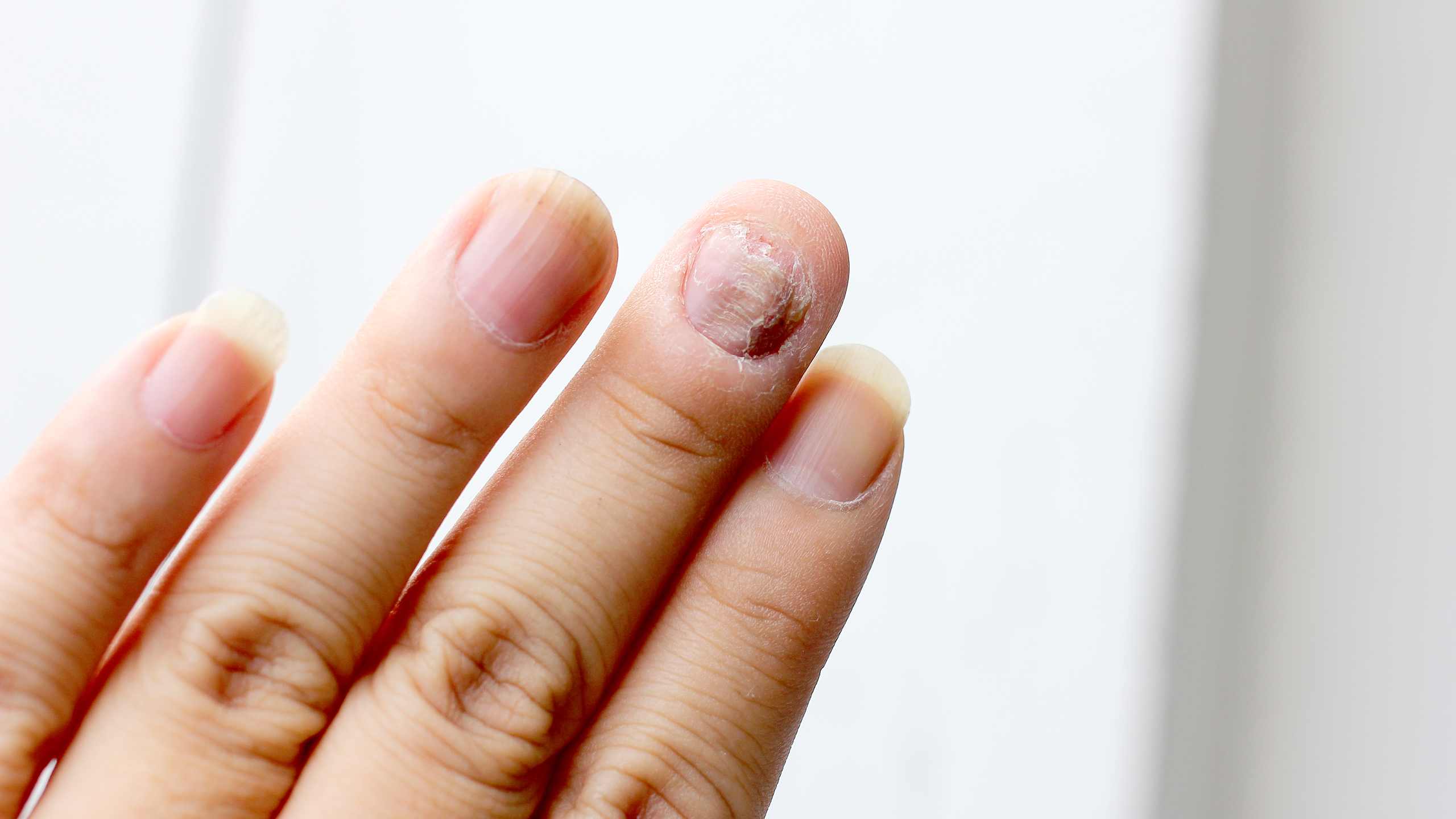 Fungal infections