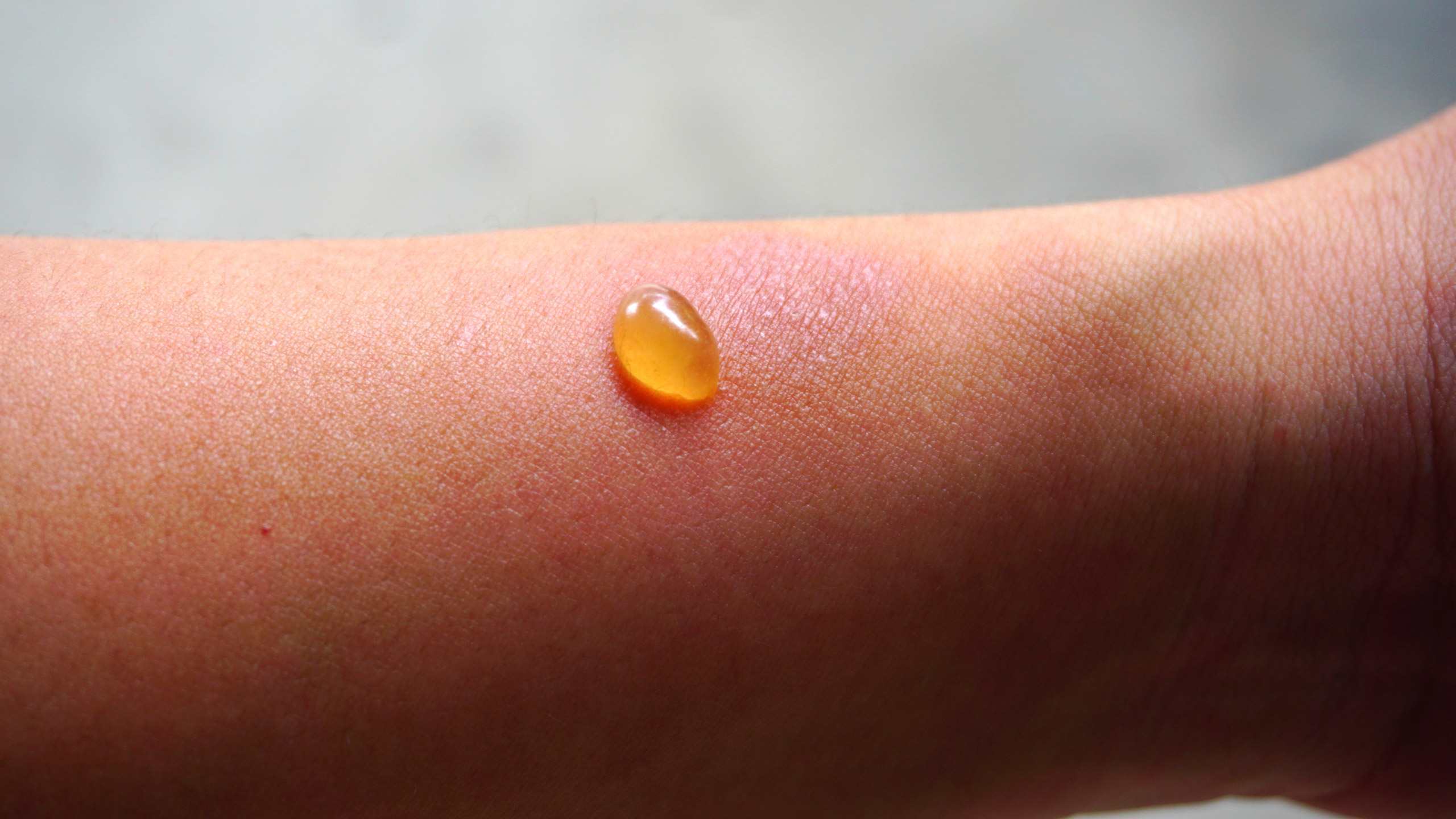 Blister beetle reactions