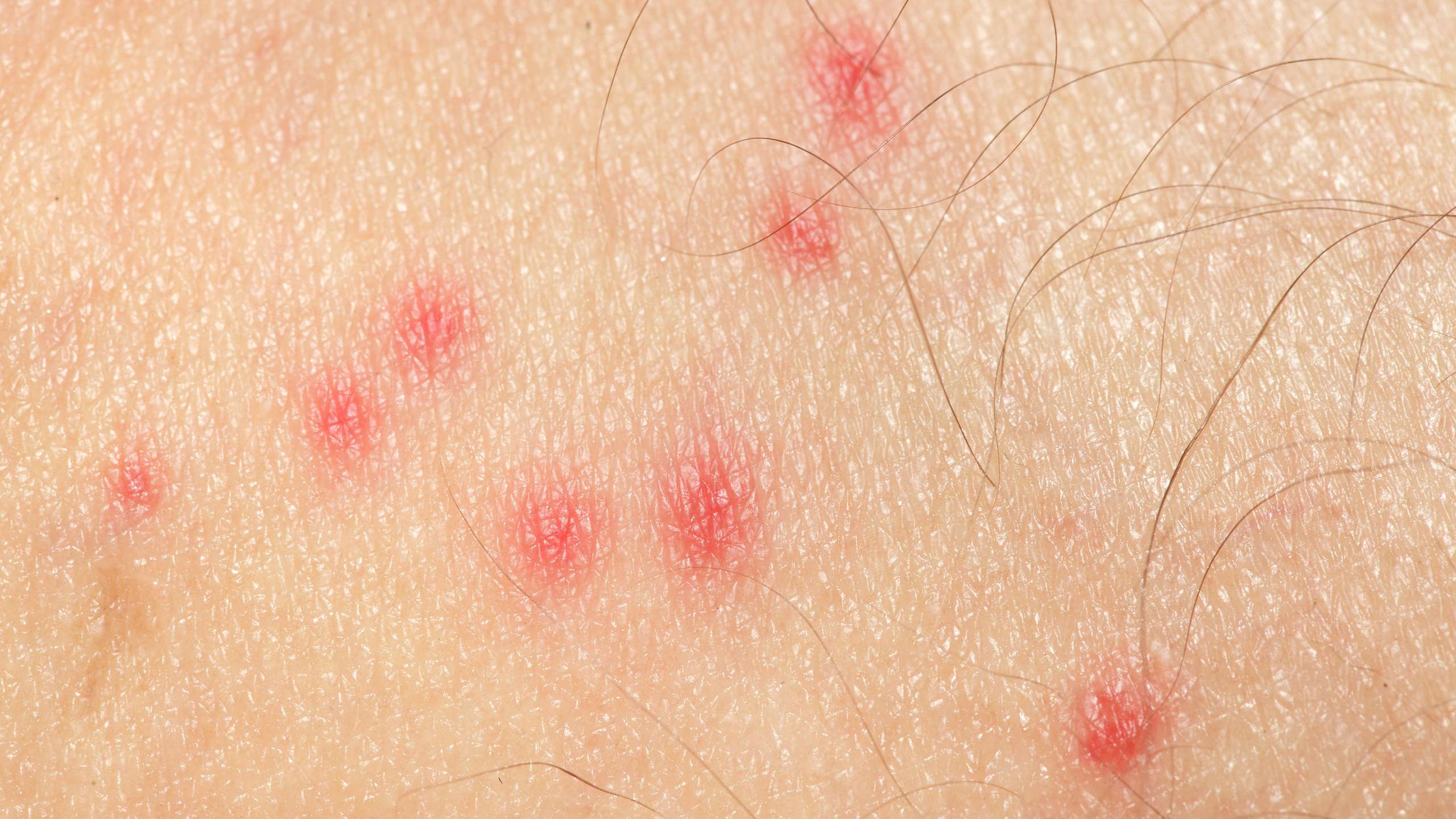 Flea bites