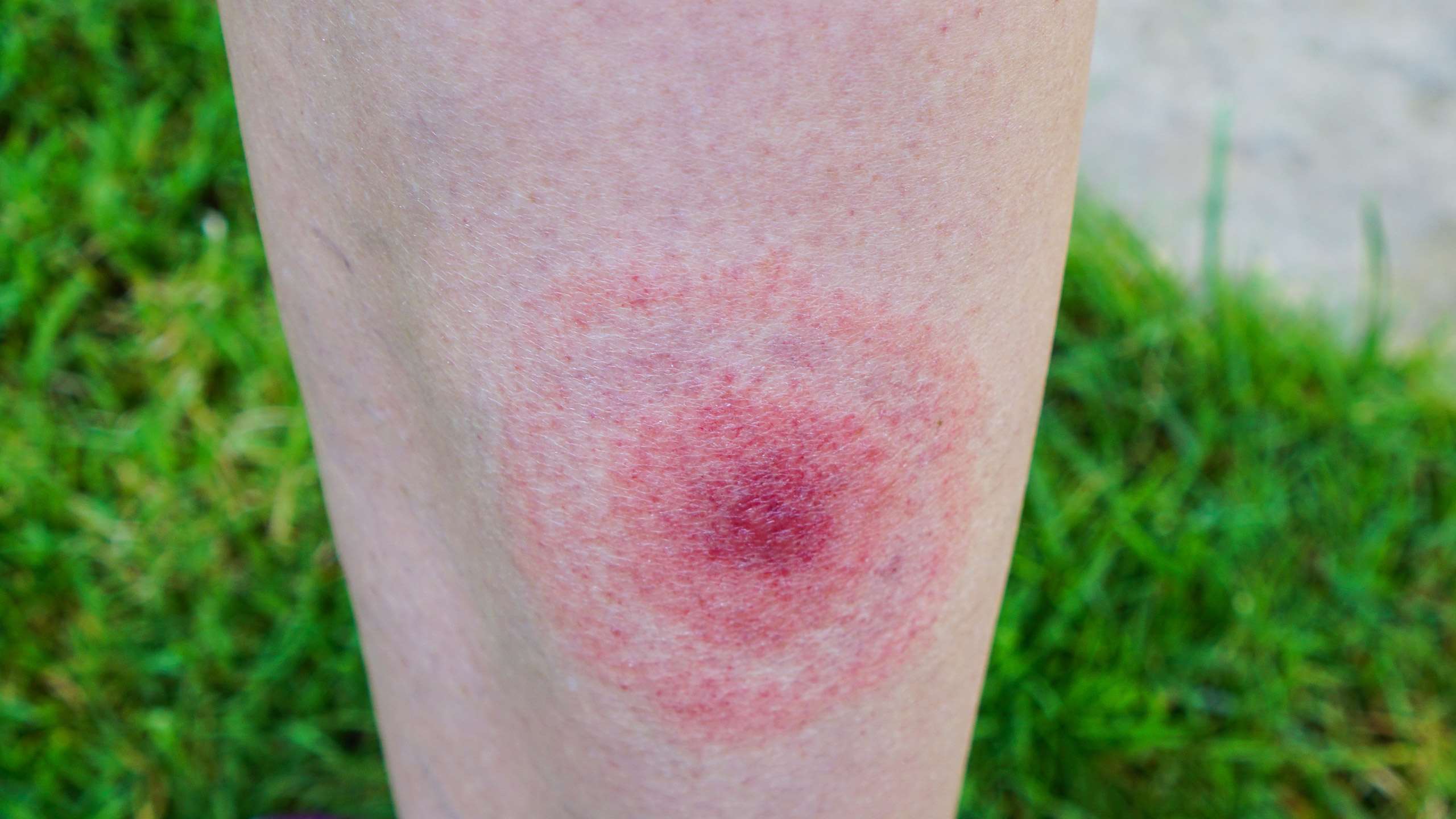 Tick bites