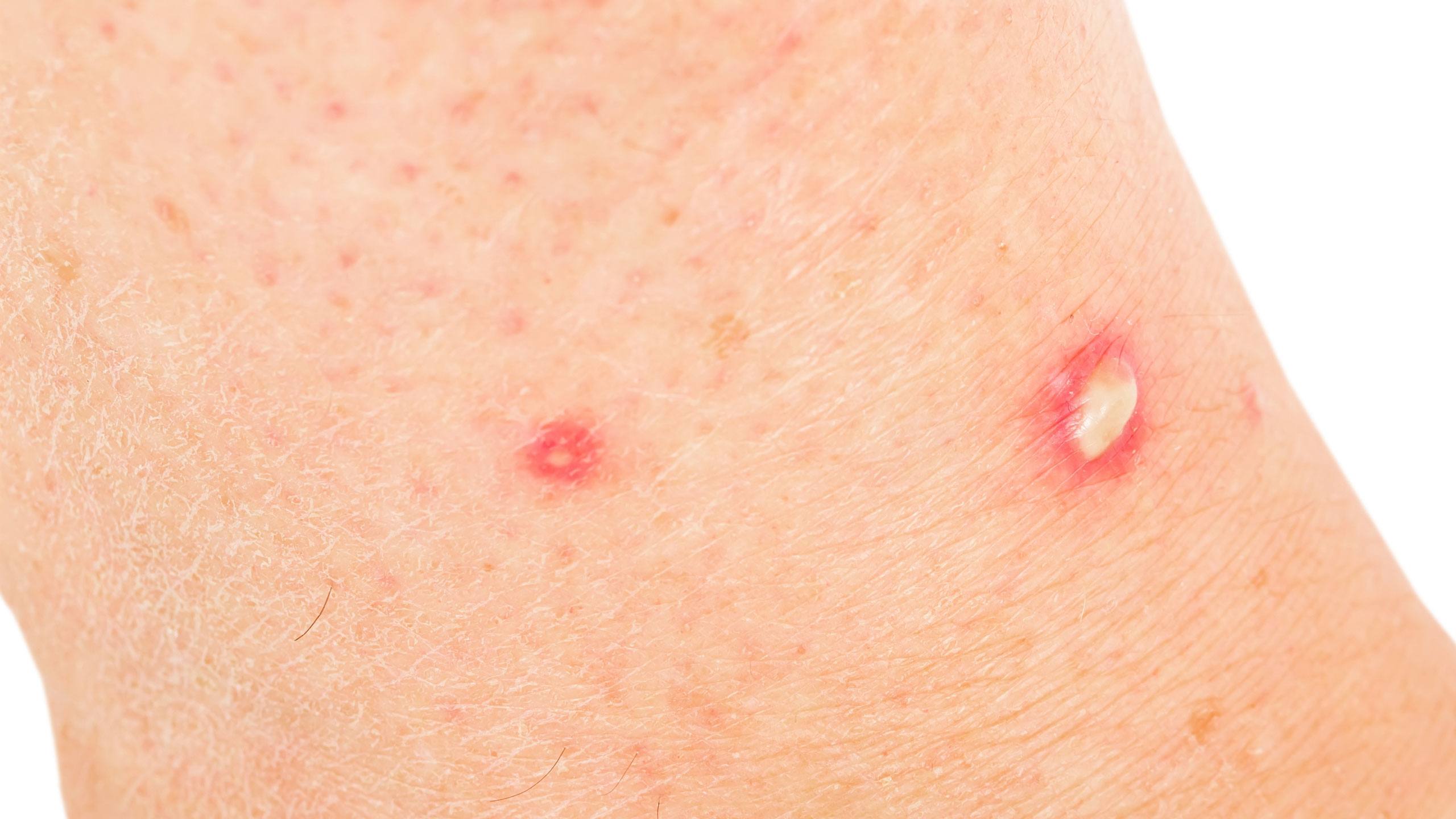 Fire ant stings