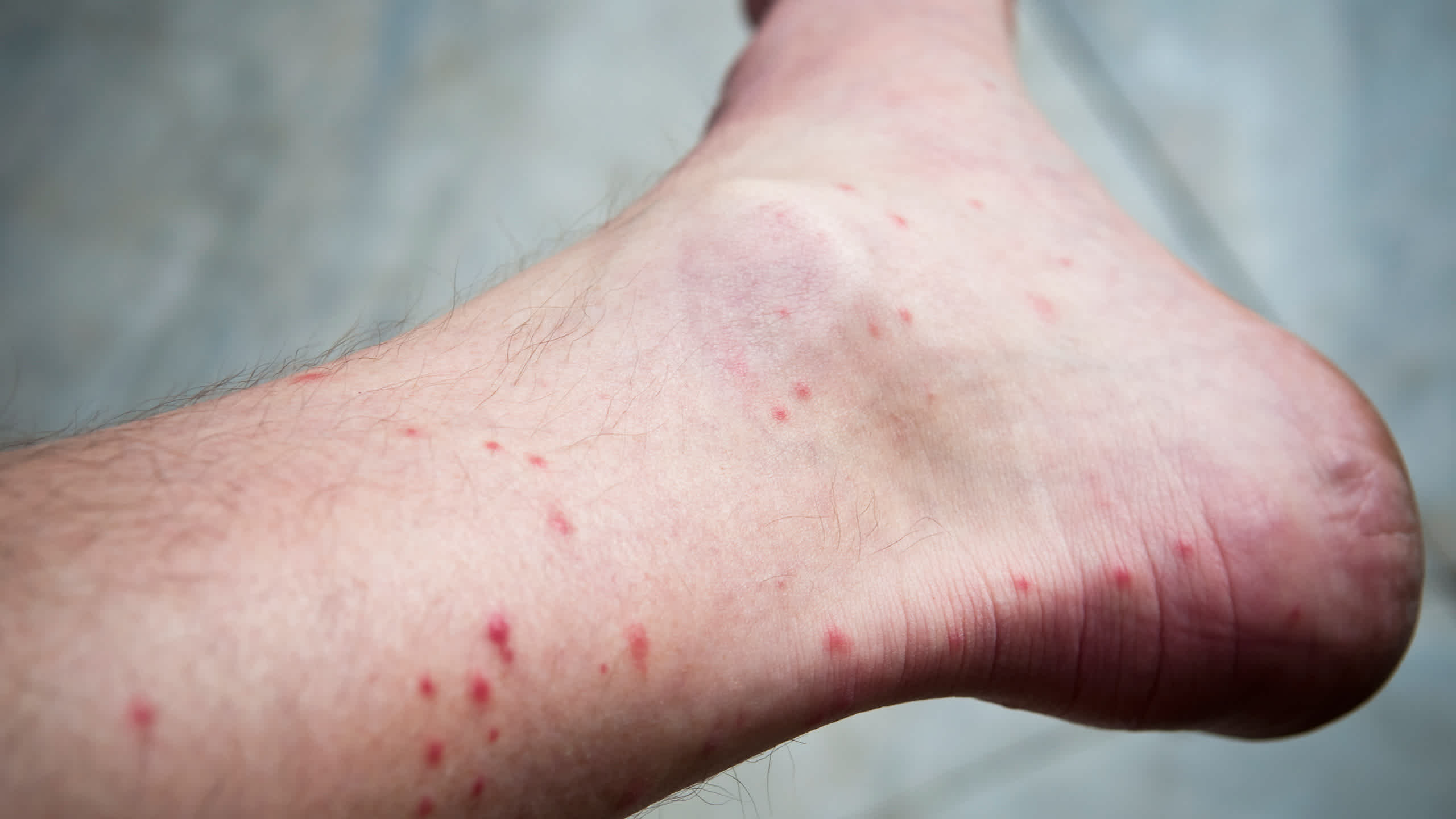Chigger bites