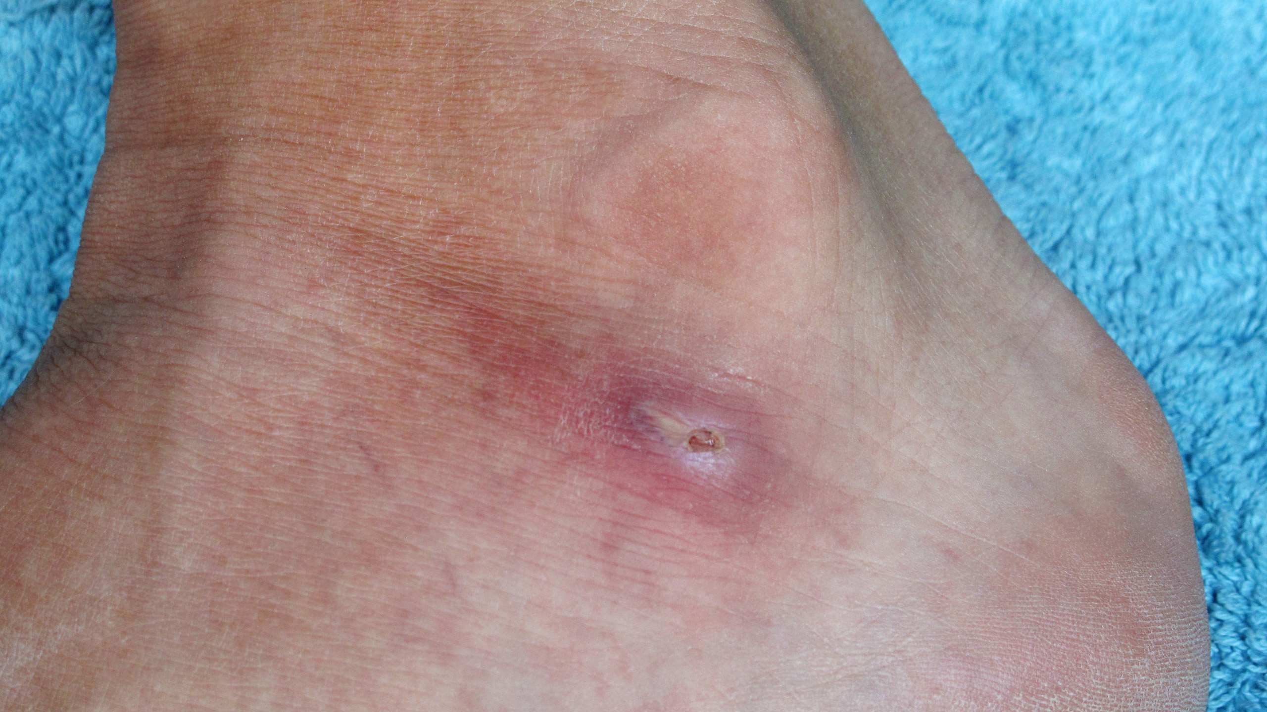 Brown recluse spider bites