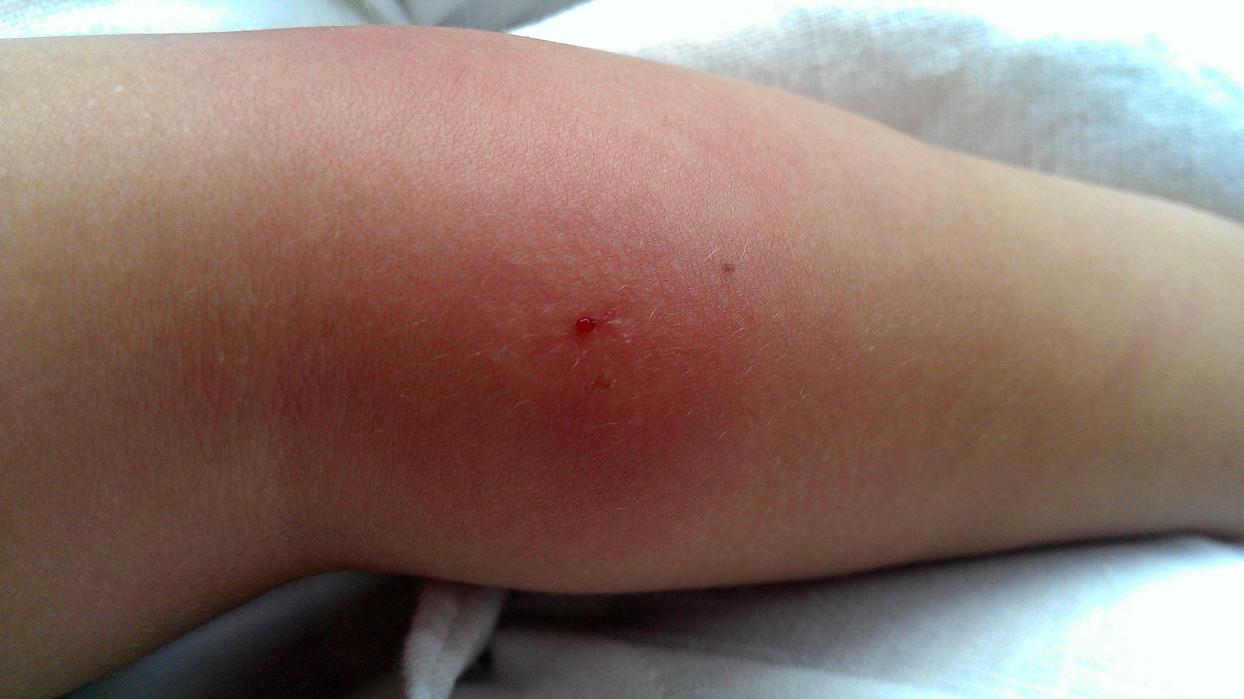 Black widow spider bite