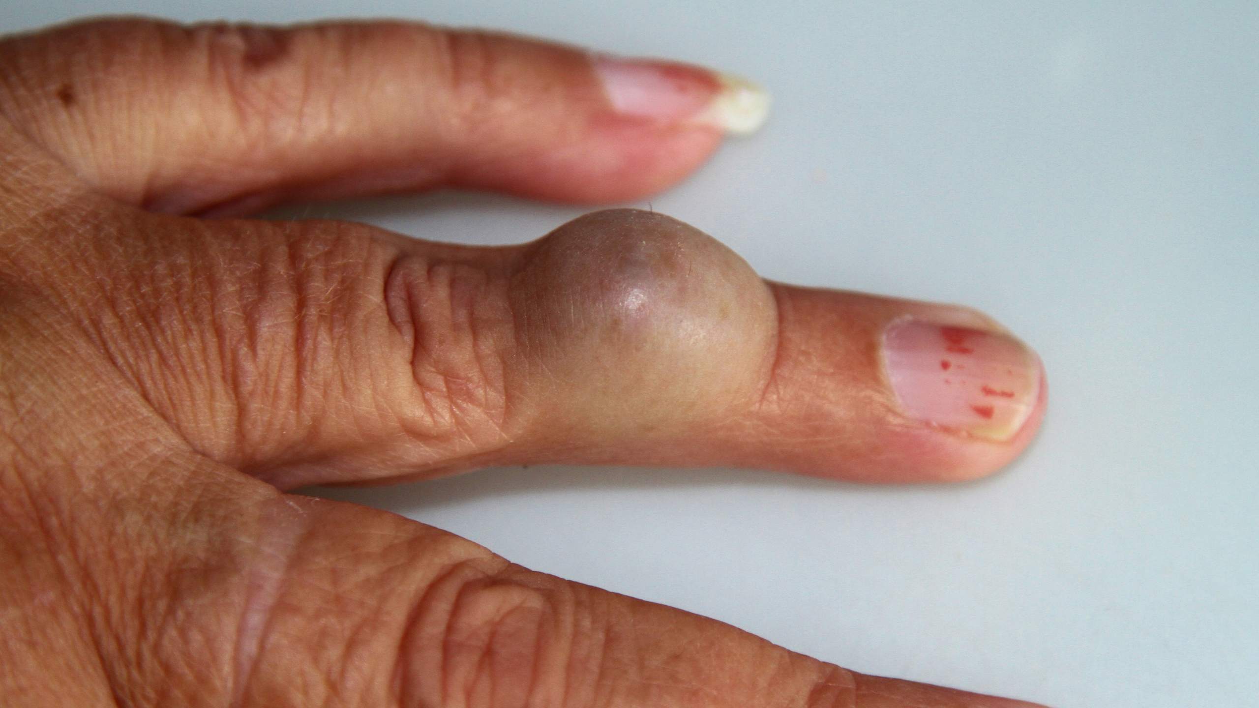 Epidermal cysts