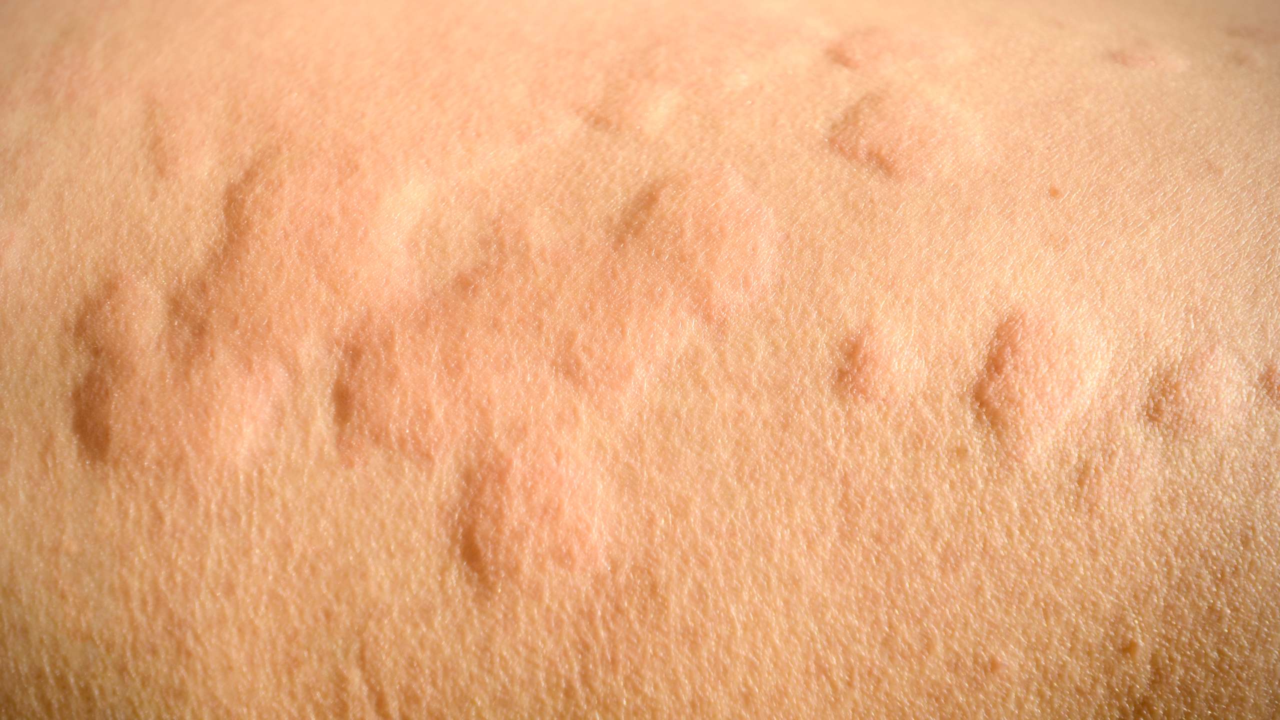Hives