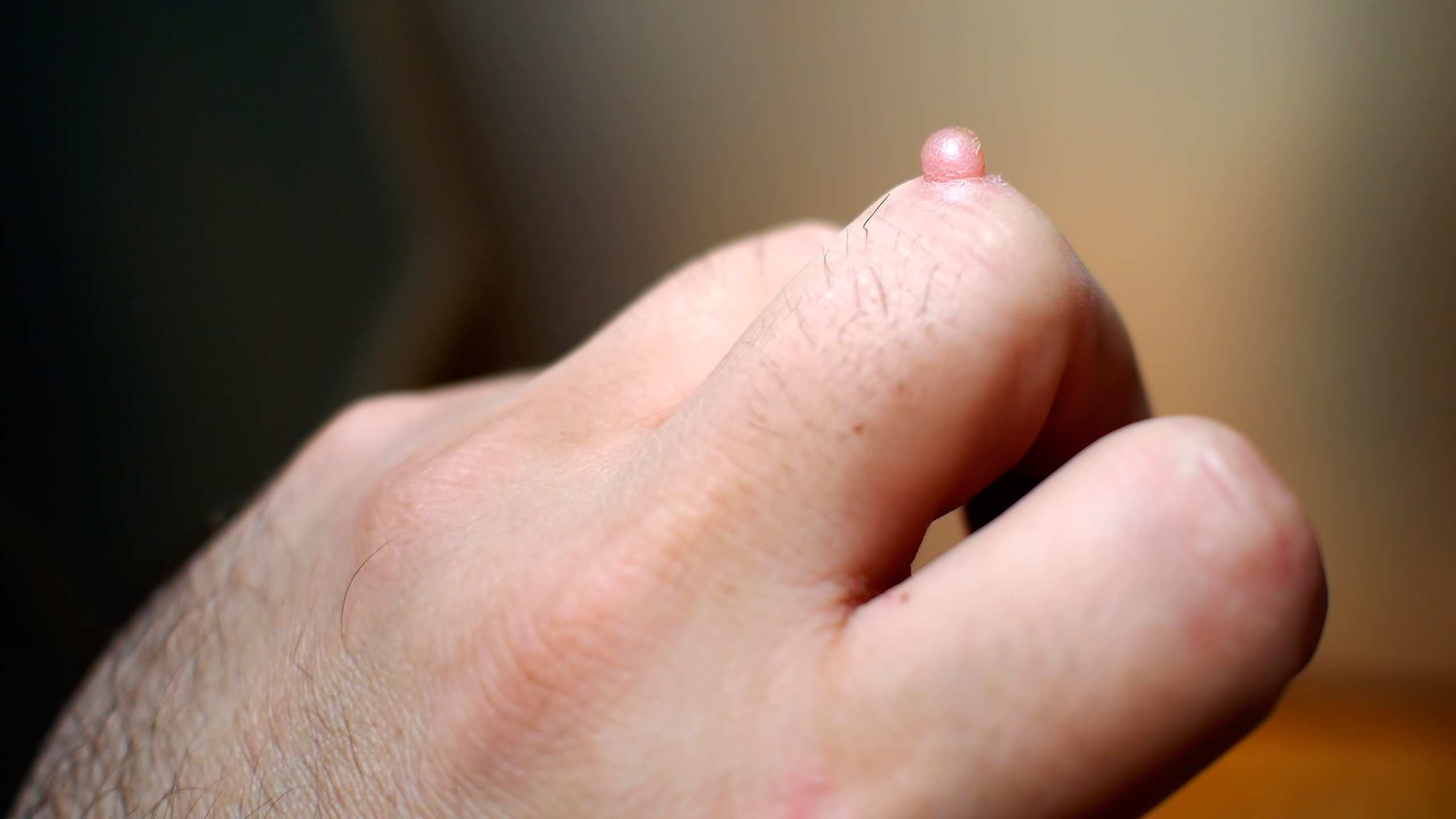 Warts