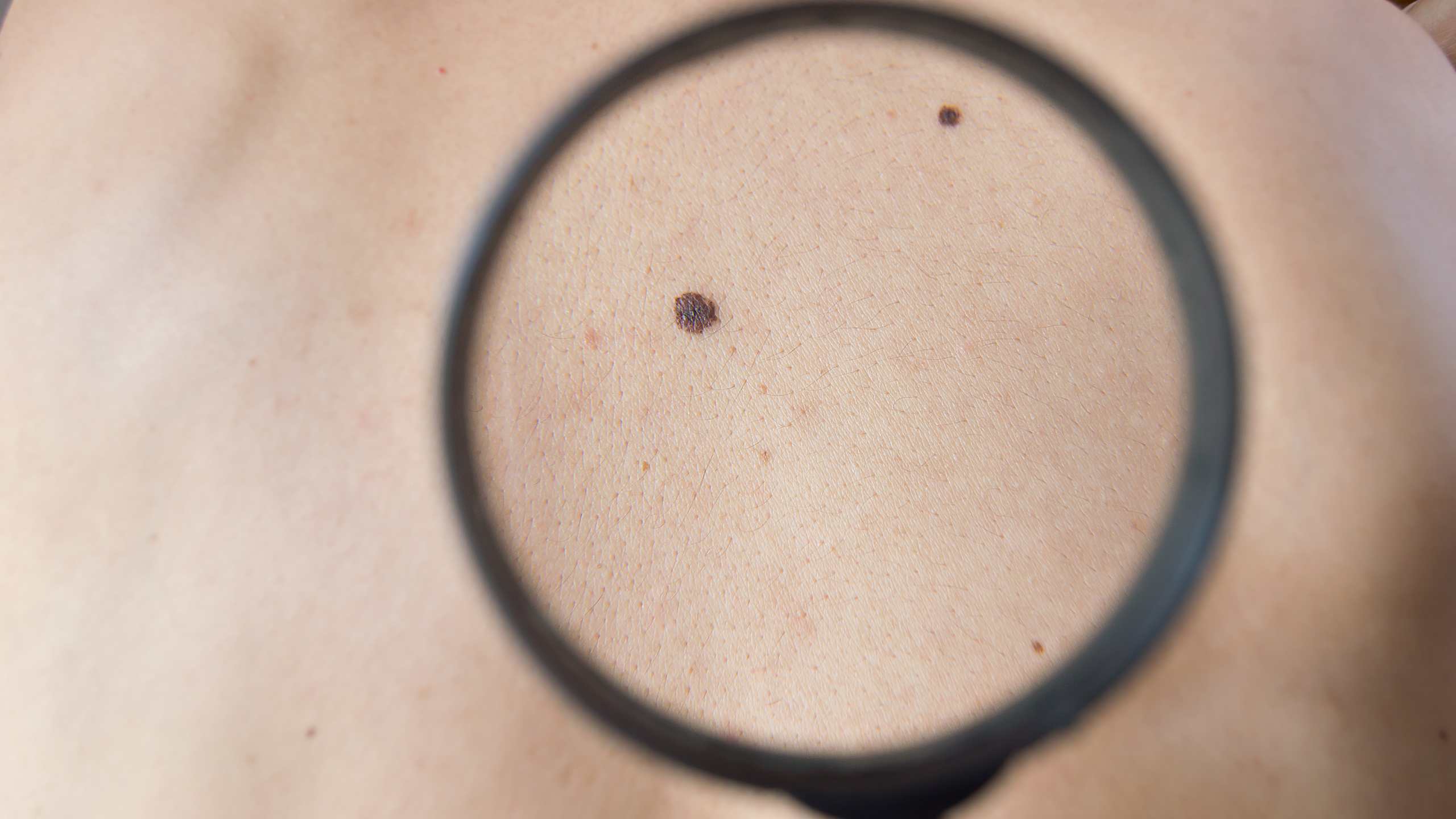 Common moles