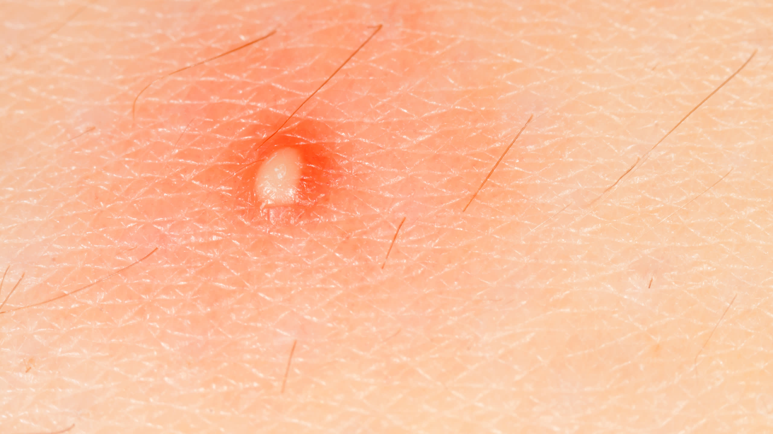 Skin boils
