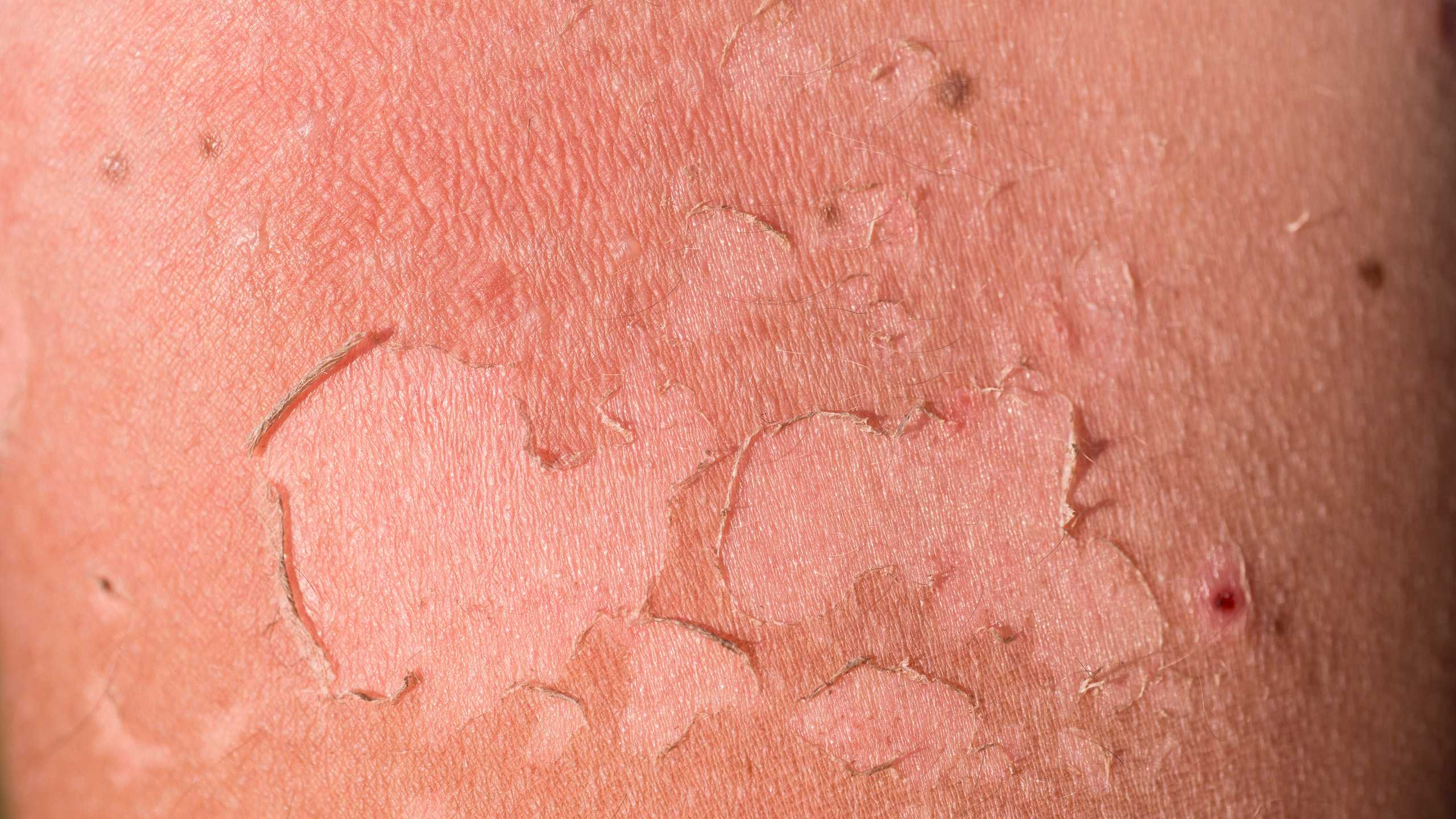 Sunburns