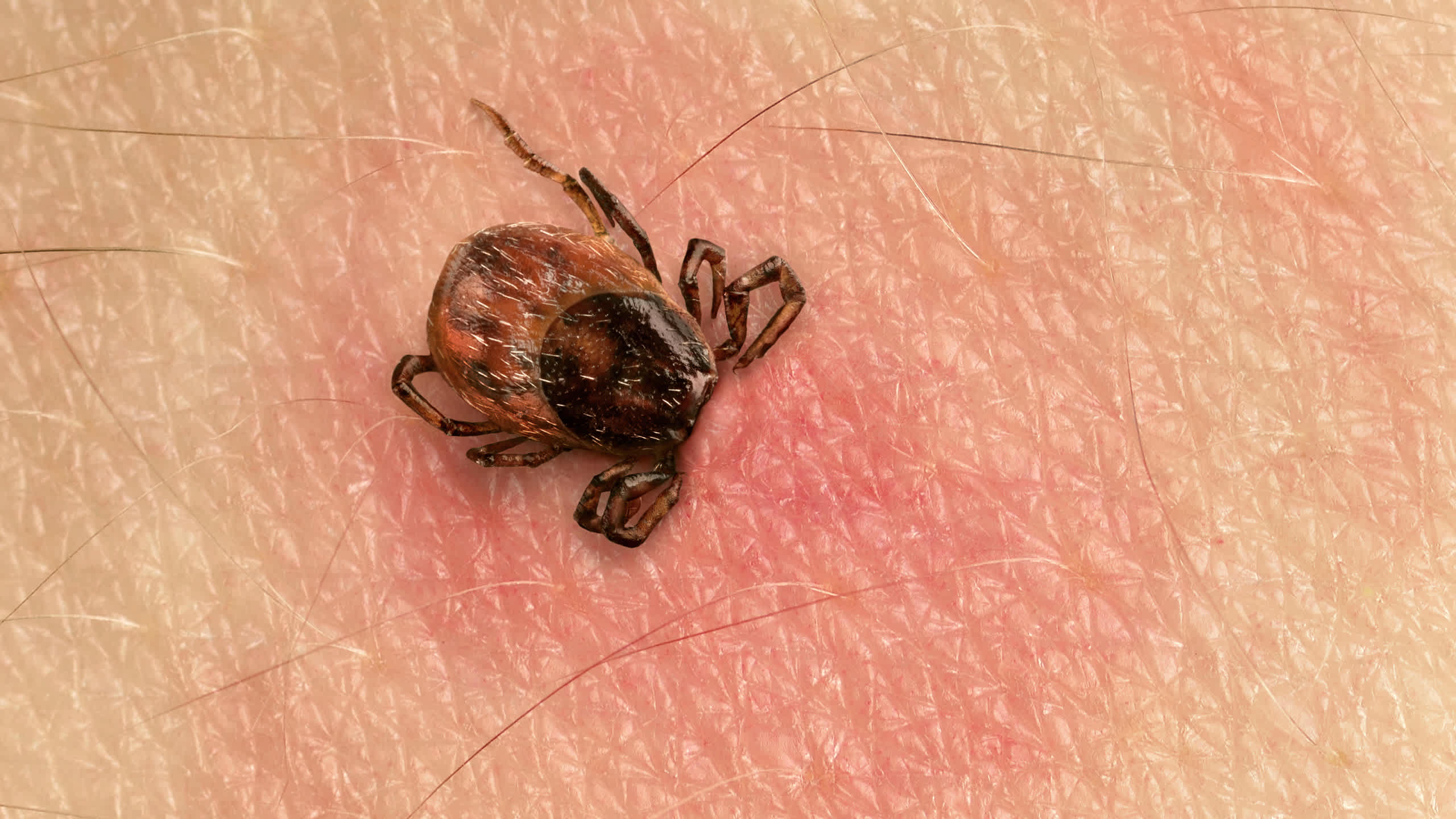 Tick Bites