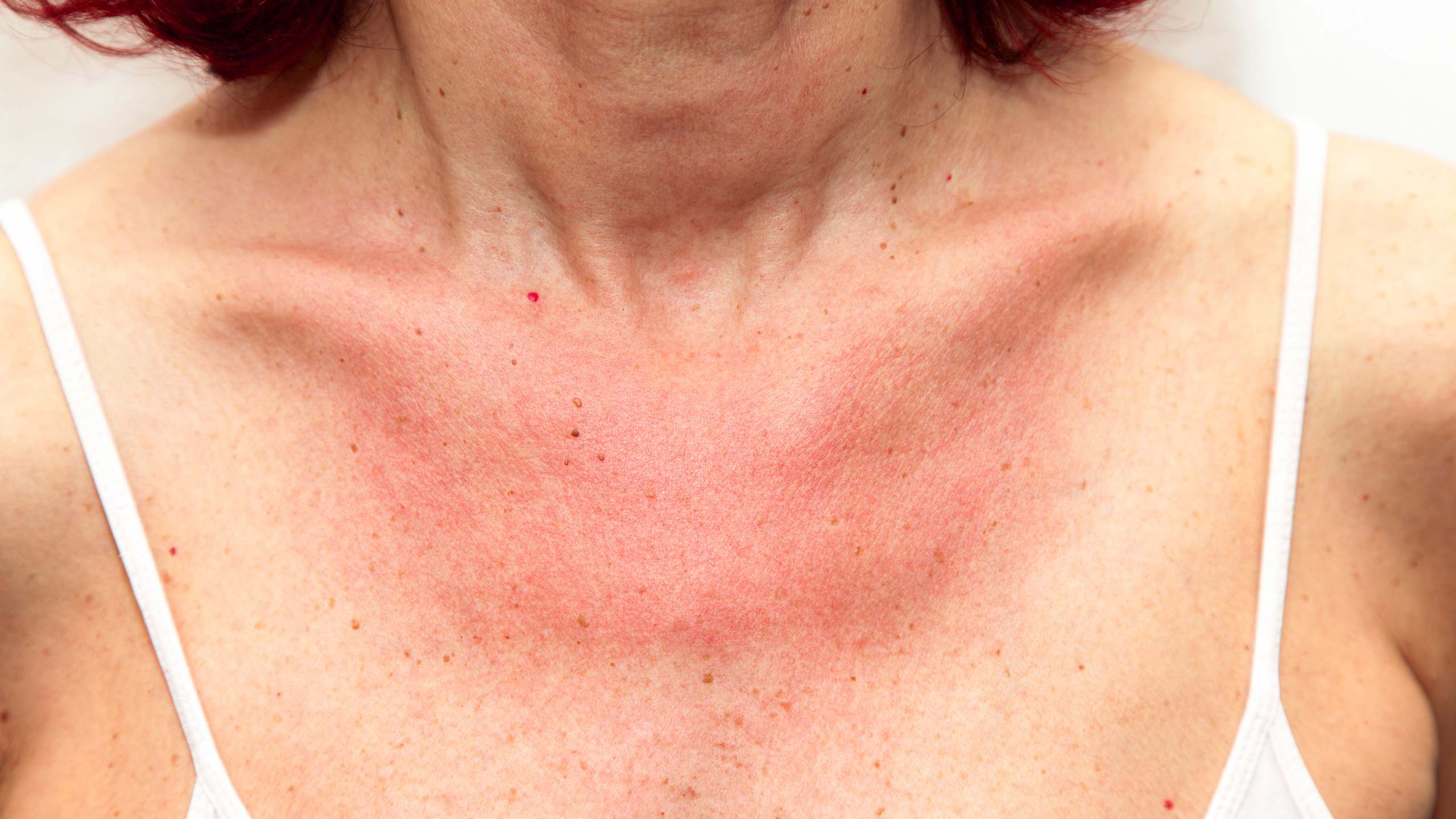 Heat Rashes