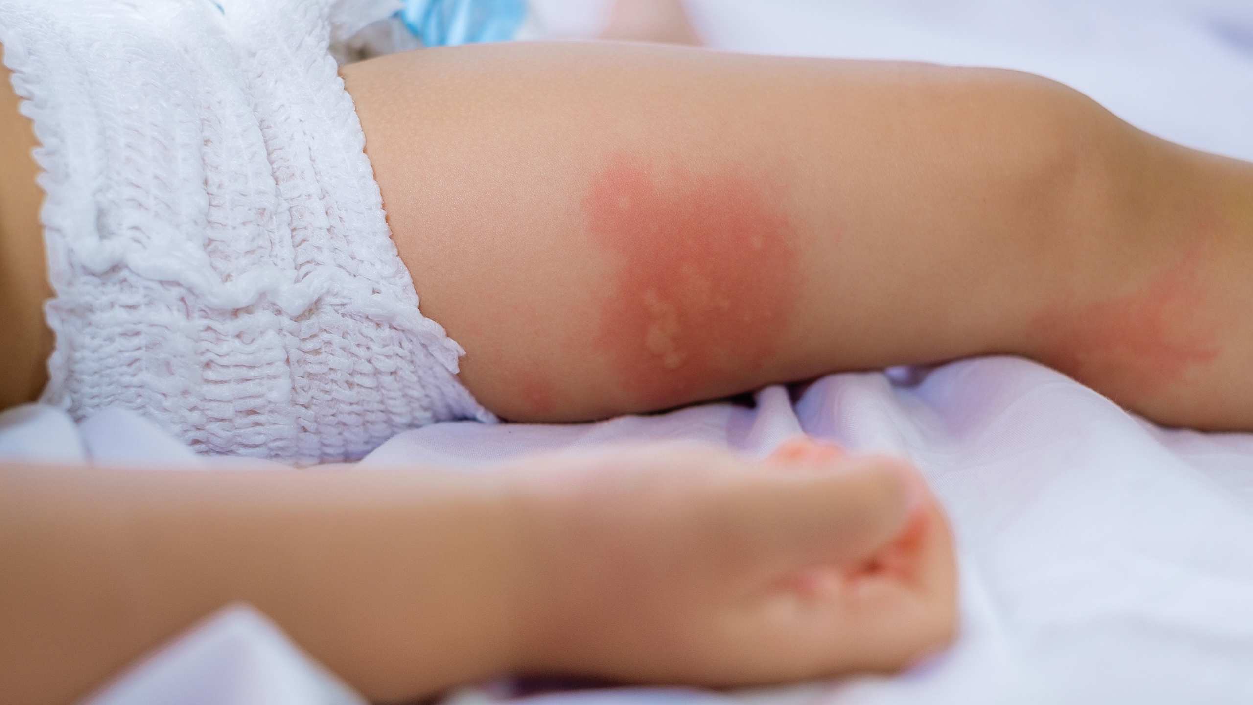 Rashes