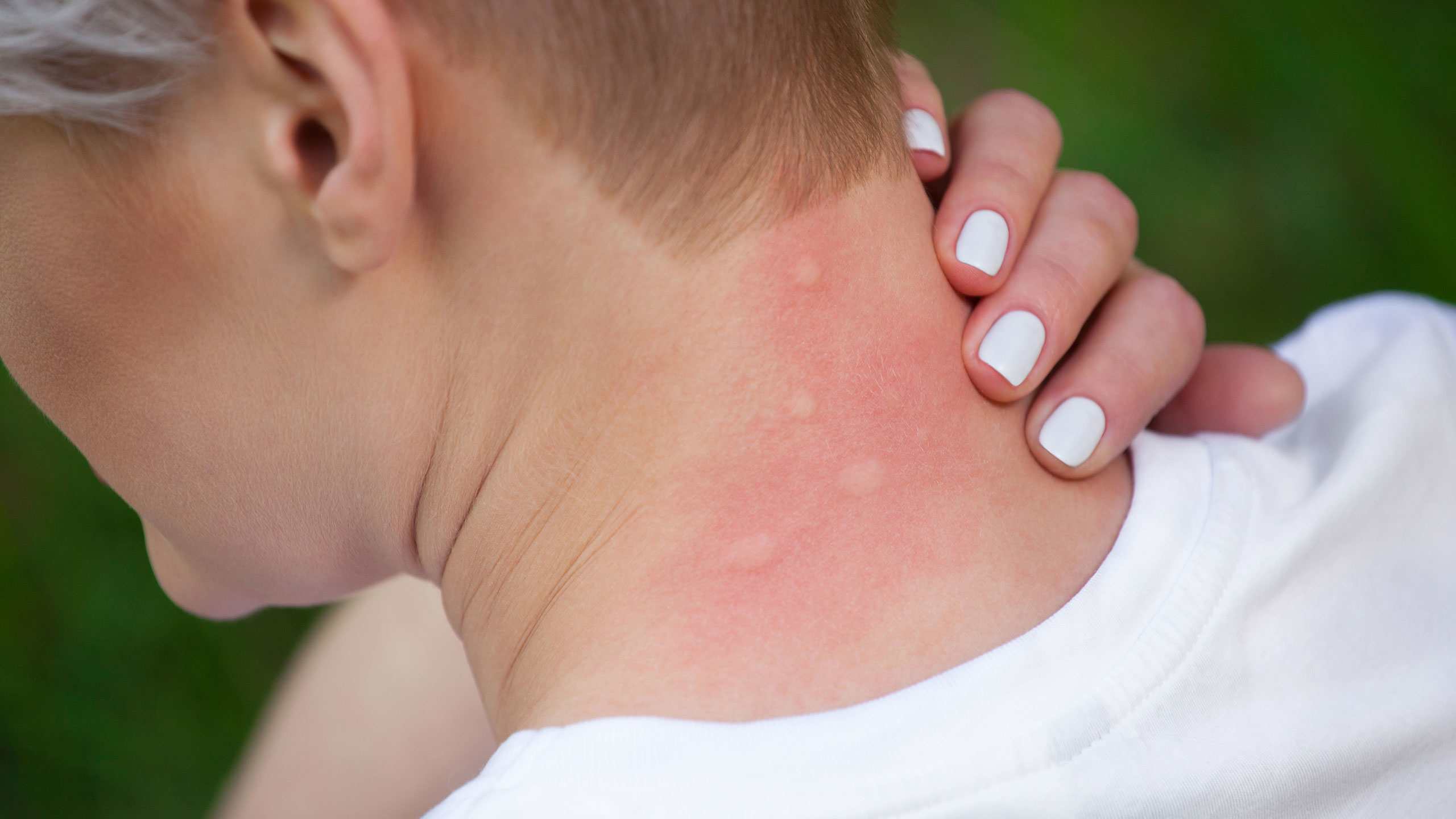 Mosquito bites