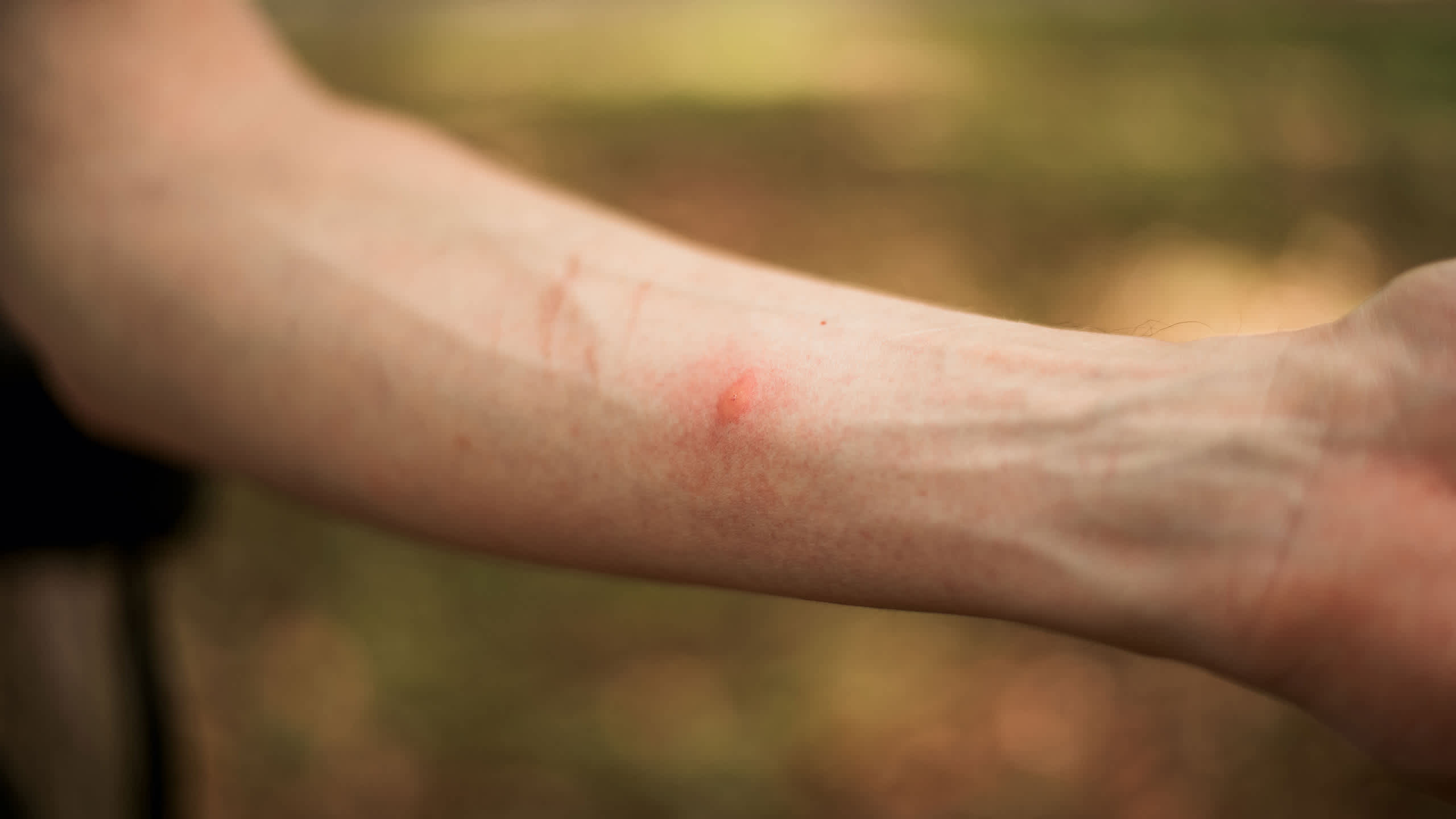 Wasp stings