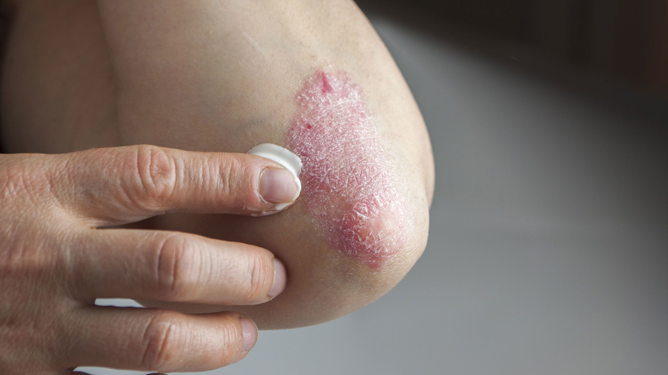 All-access guide to five common skin conditions