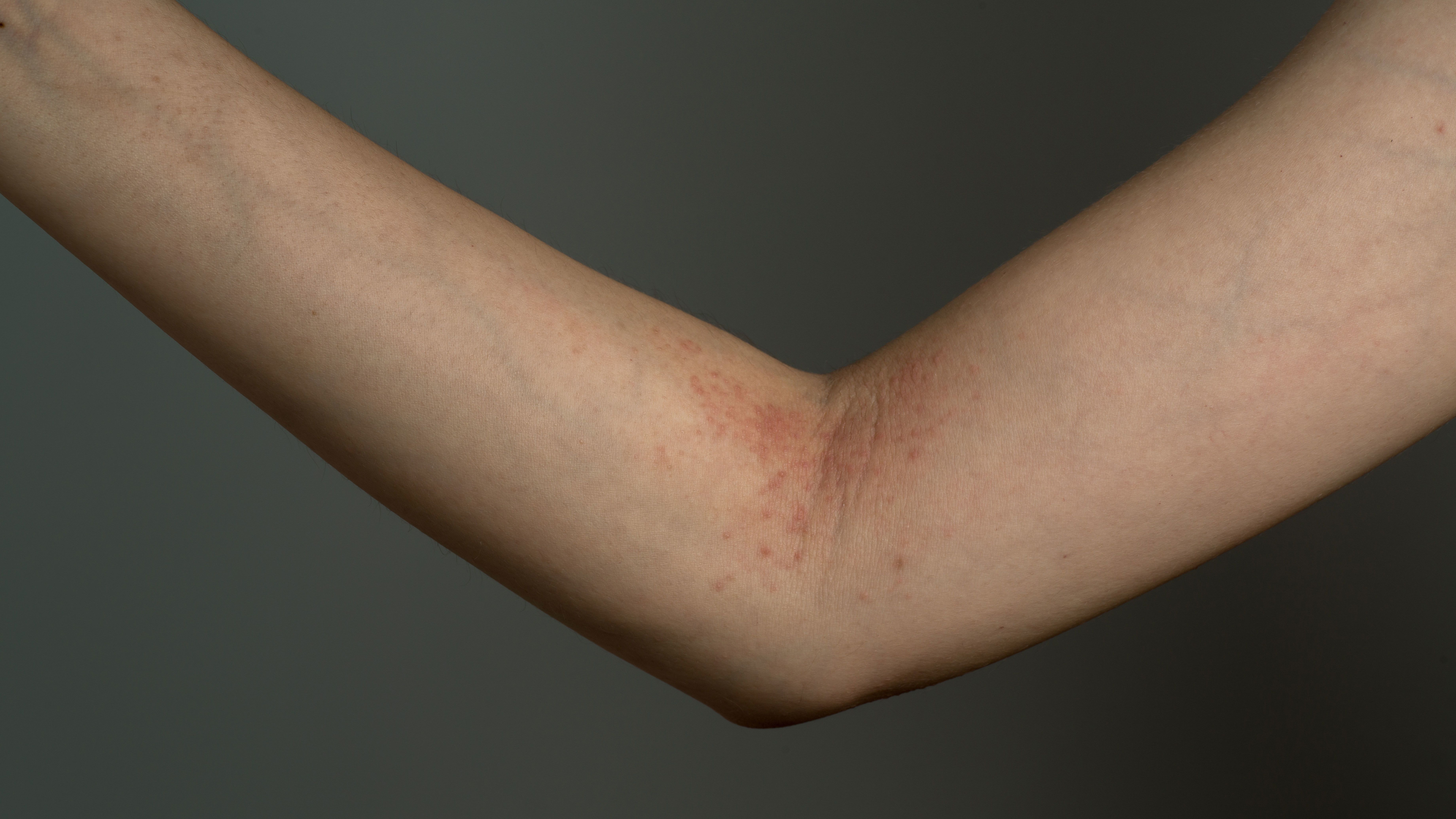 6 Things That Can Worsen Atopic Dermatitis