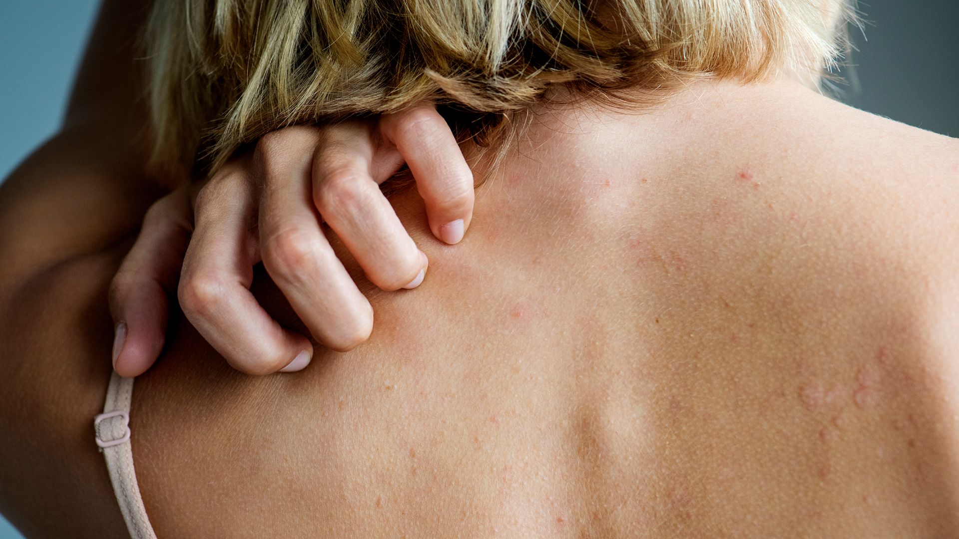 Is It Shingles, Psoriasis, Eczema or Something Else?