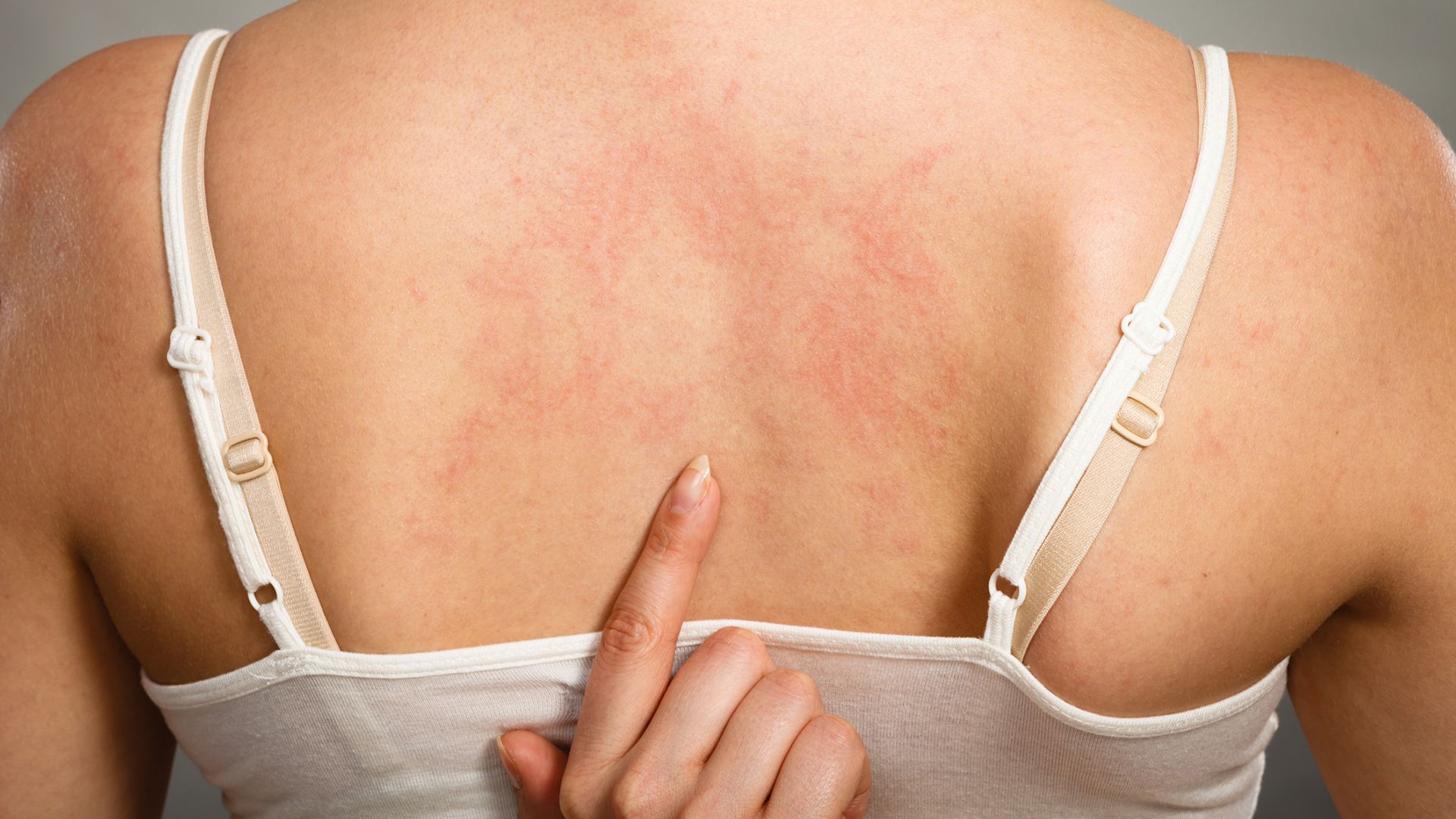 What causes hives?